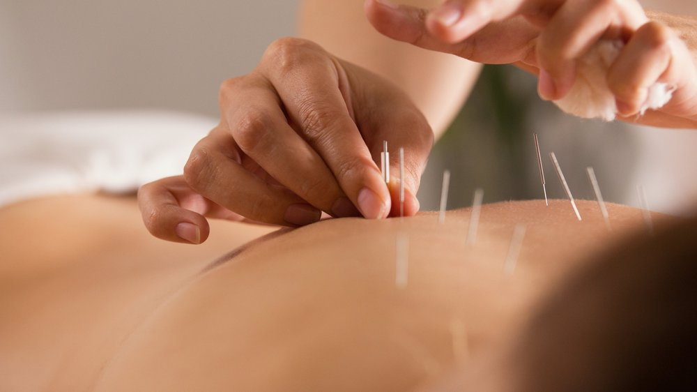 Dry Needling vs Accupuncture - MGS Physio