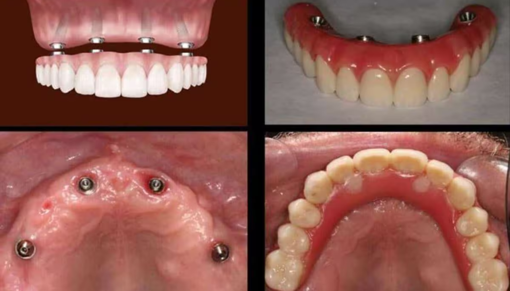 Fire trinn som viser tannimplantater og fast protese ved full munnrehabilitering med All-on-4 behandling.