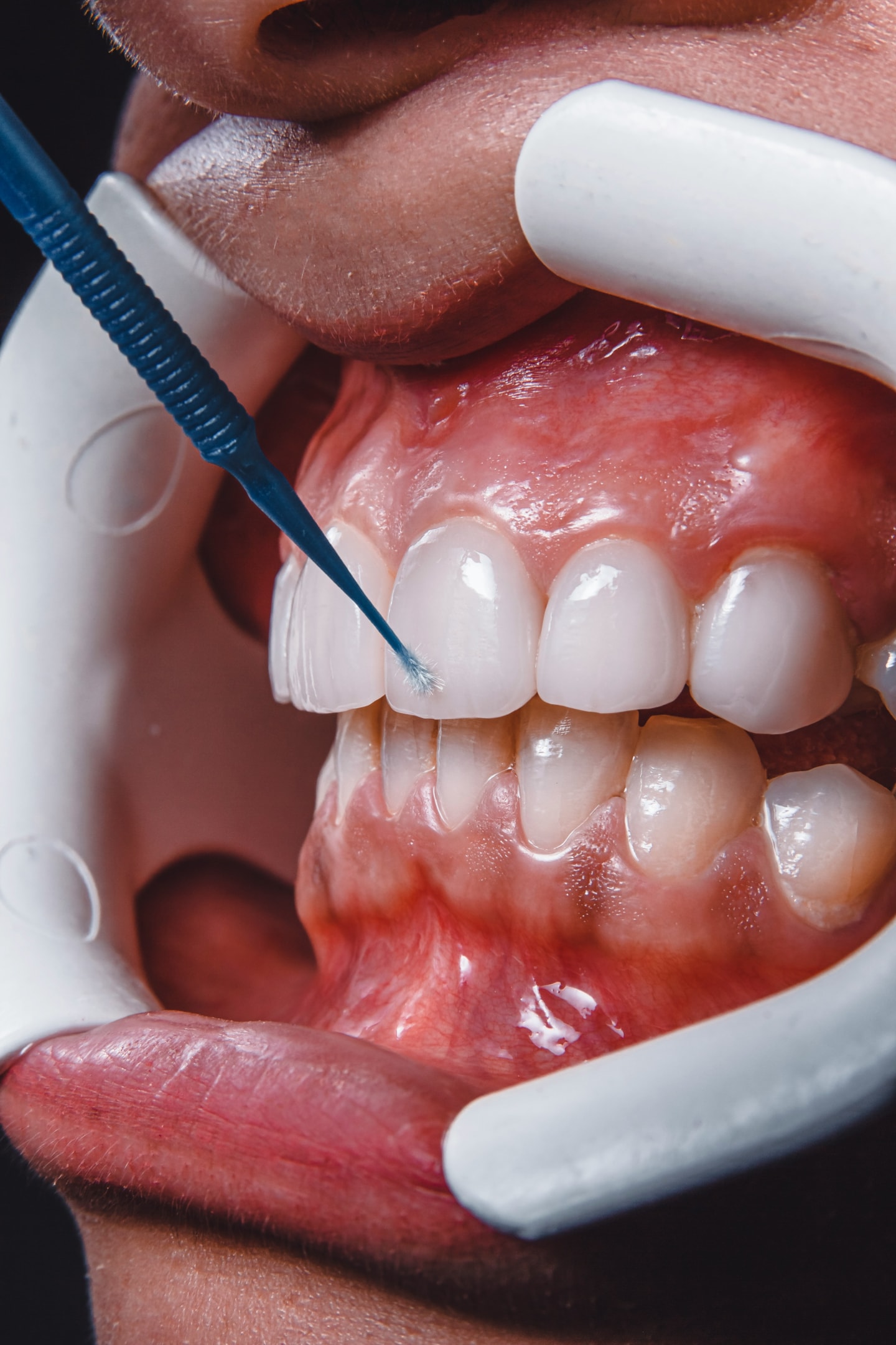 An illustration of white fillings being applied to a tooth, showcasing the dental procedure.