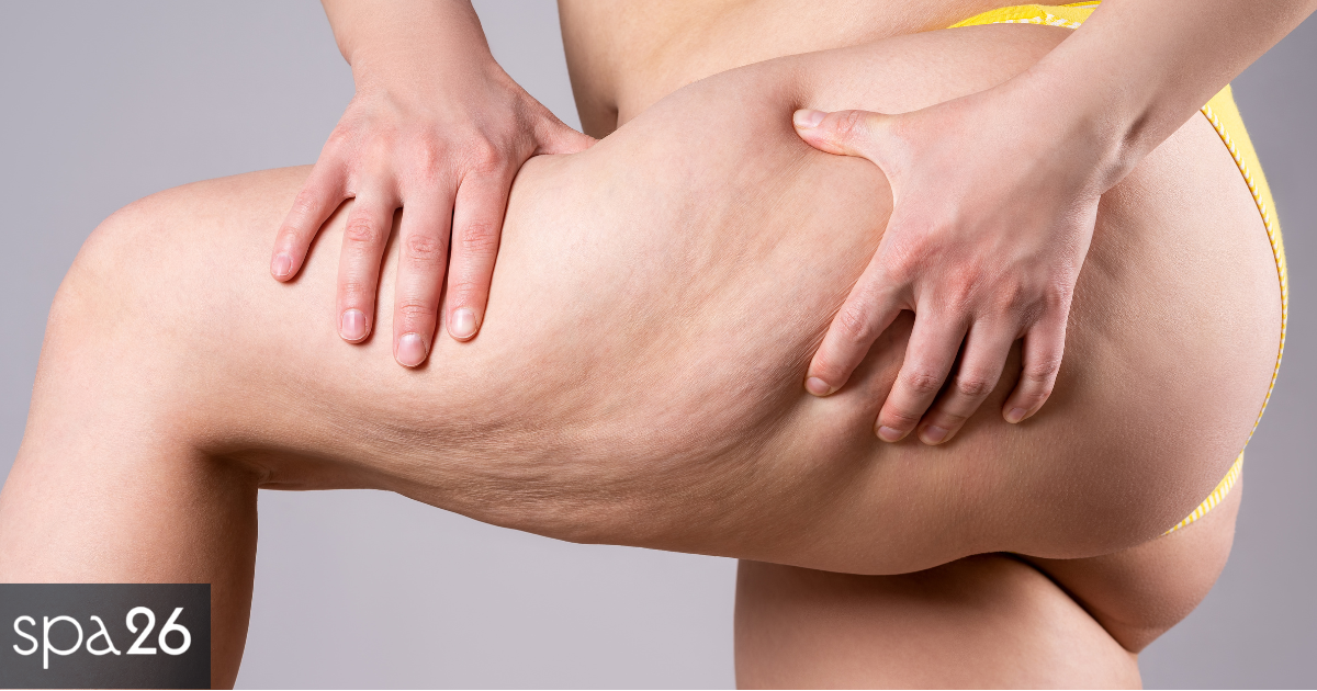 Cellulite