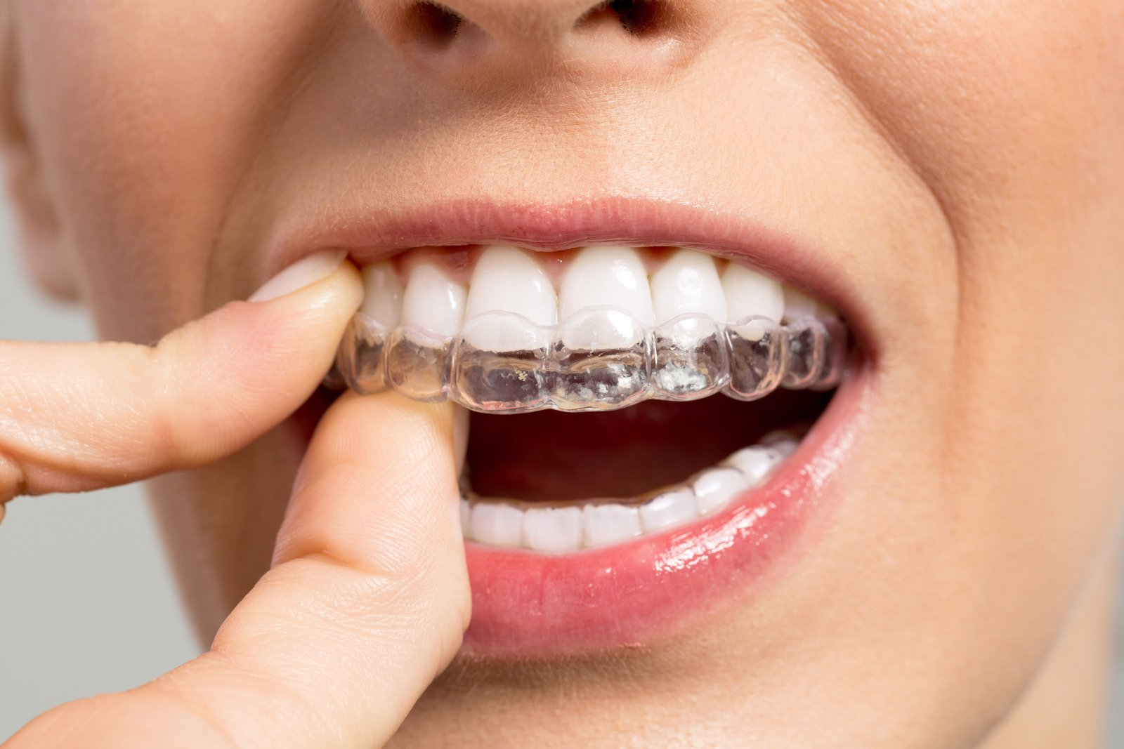 Clear aligners, pain or discomfot, pain relief