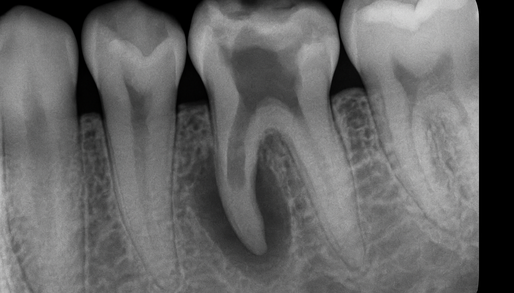 Røntgenbilde av tann med tydelig resorpsjon i roten, omgitt av friske tenner og kjeveben i svart-hvitt kontrast.