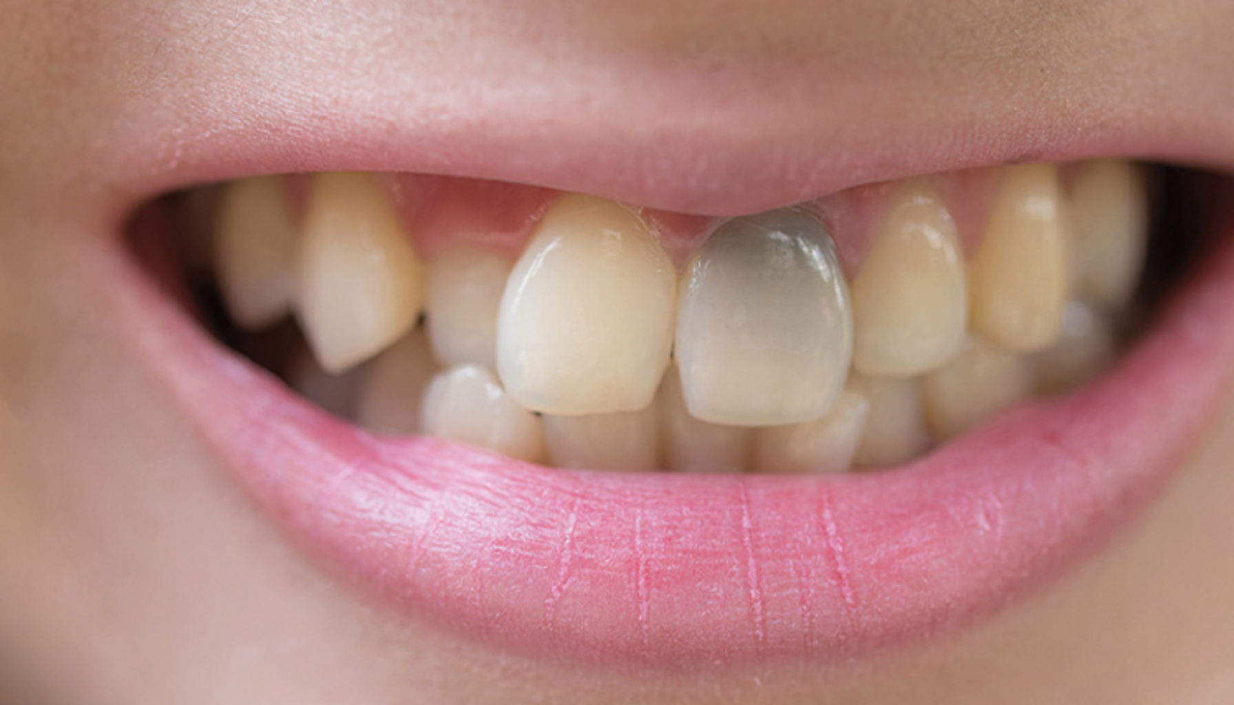 Død Tann? Slik Vet Du Om Tannen Har Sjekket Ut (Men Du Fortsatt Må Inn) 12 Nærbilde av en person som smiler med misfargede og gule tenner, der en tann er mørk og tydelig skadet.