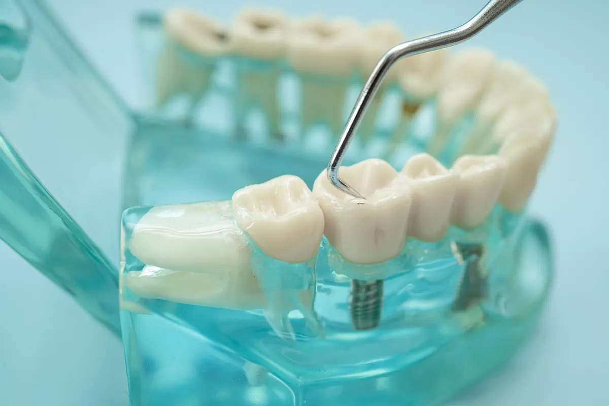 Dental implant model showing prosthetic teeth with titanium implant on transparent blue base, with dental probe pointing to crown.