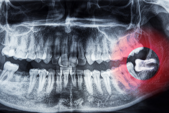 x-ray showing an impacted wisdom tooth