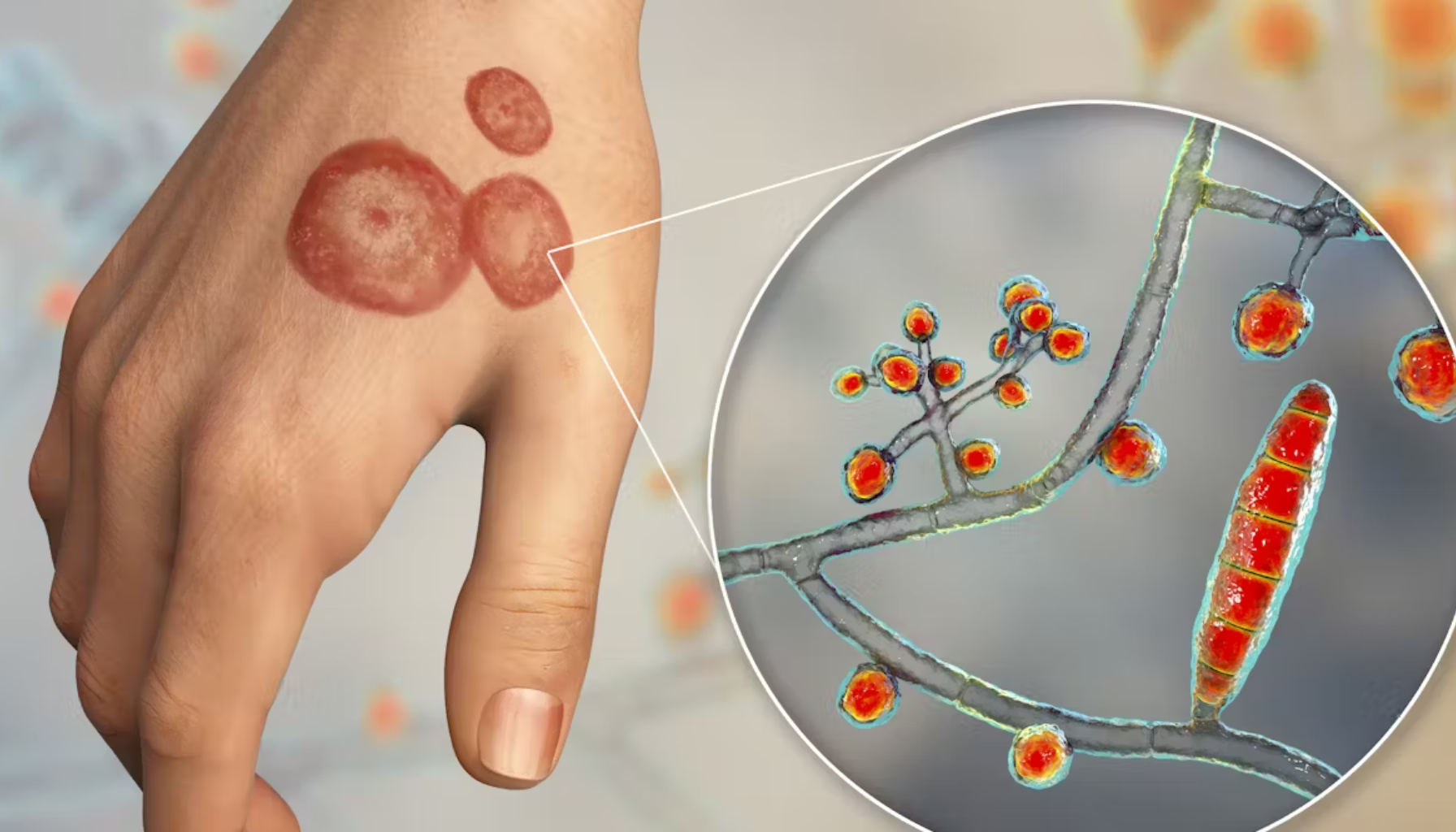 Candida: Den skjulte soppen i kroppen din 16 Ringorm på hånden med nærbilde av soppinfeksjon under mikroskop.