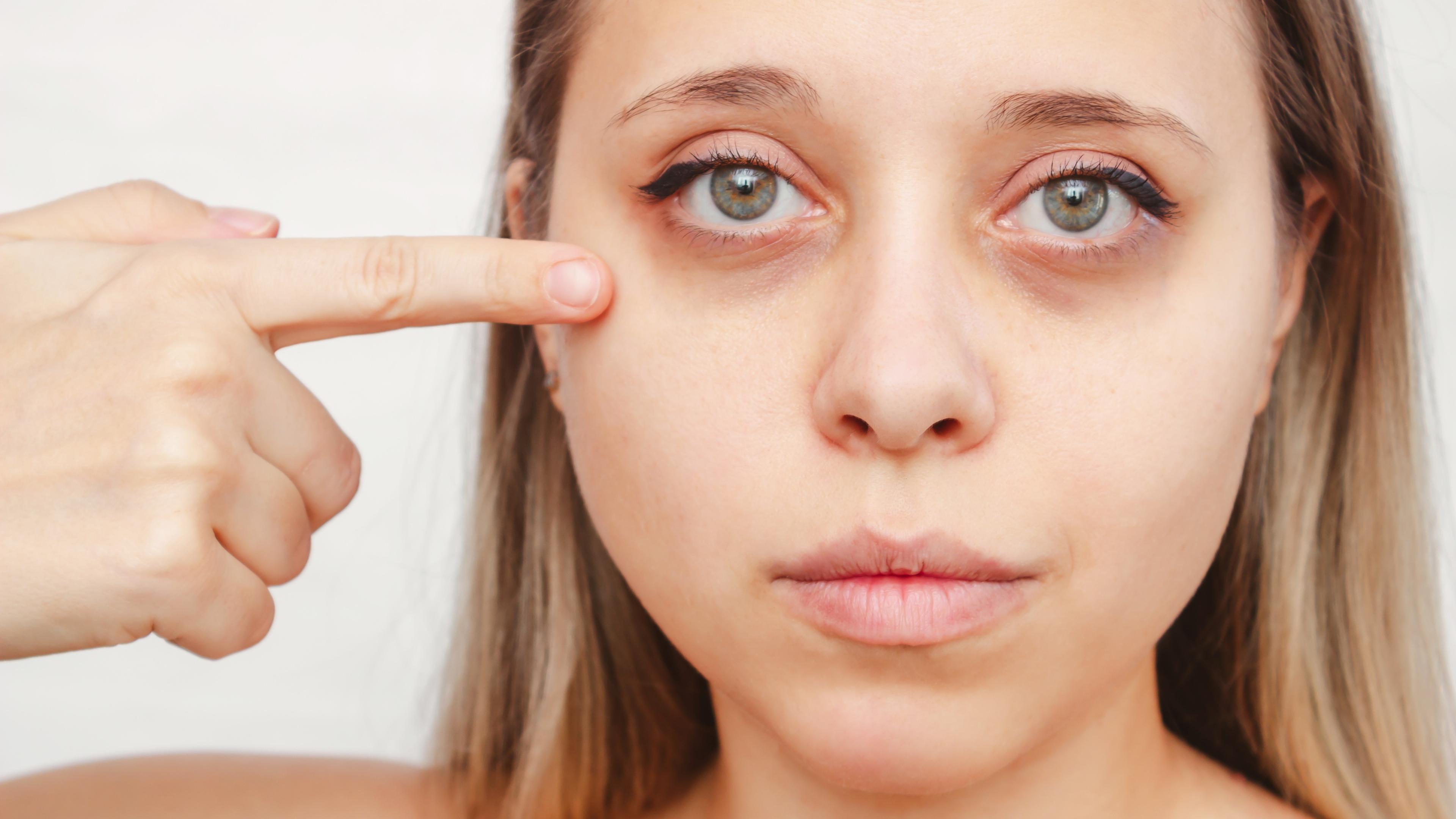 Plastyka powiek – blizny u kobiety na zdjęciu.