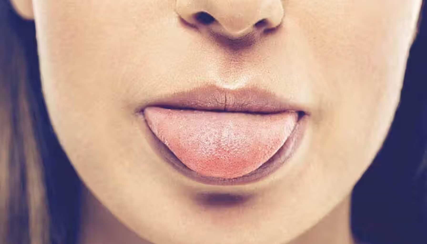 Hovne og røde flekker på tungen, tydelig tegn på irritasjon eller mulig betennelse i munnens slimhinne.