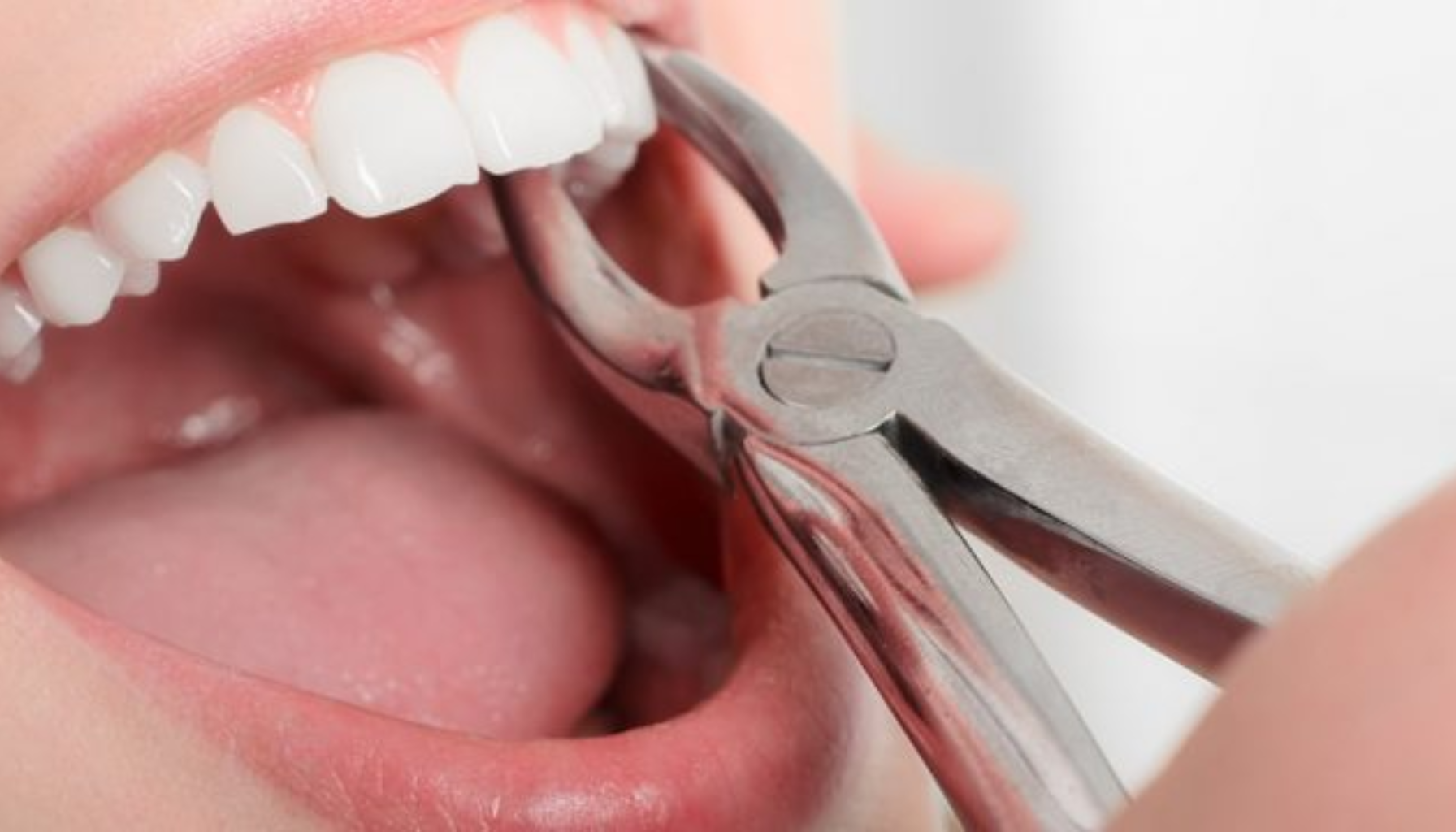 Trekke Tann: Når Det Ikke Lenger Er Noe Å Redde (Men Alt Å Vinne) 11 Nærbilde av en tann som blir trukket ut med tenger fra en åpen munn med hvite tenner.