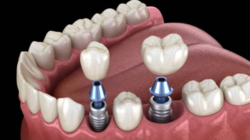 O-ring seals used to protect dental implants