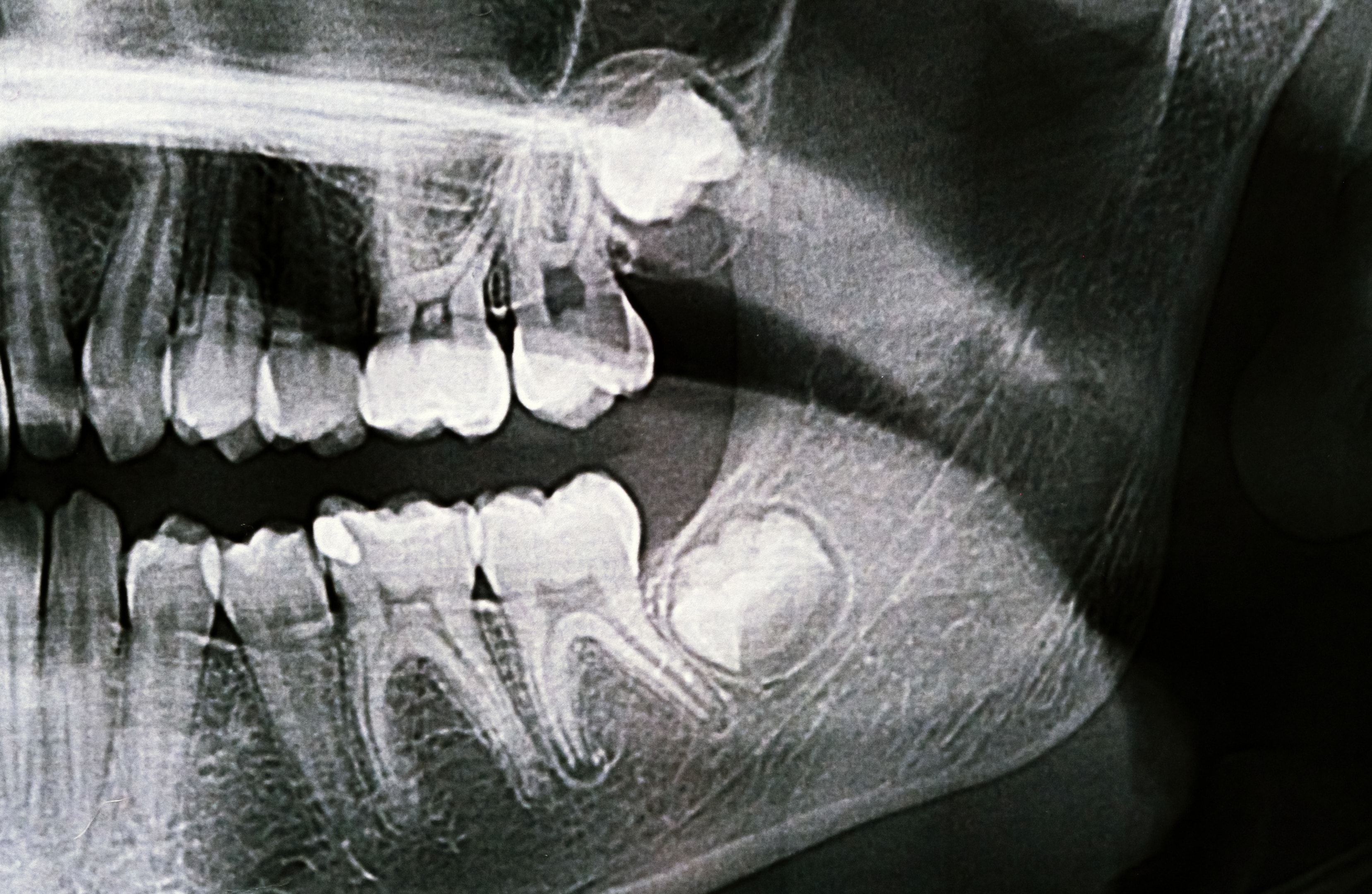 half x-ray of a kids mouth to show their teeth
