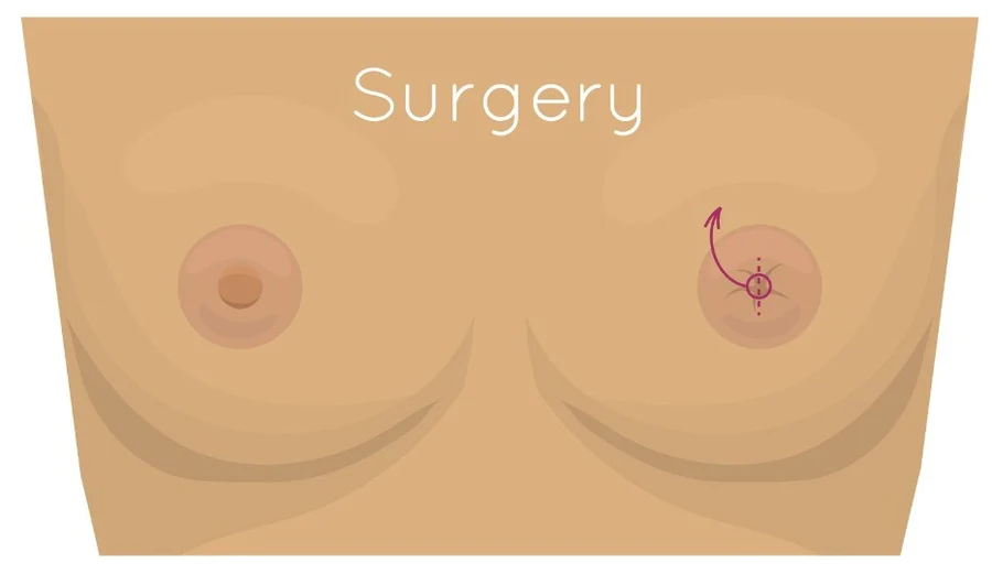 Illustration of inverted nipples