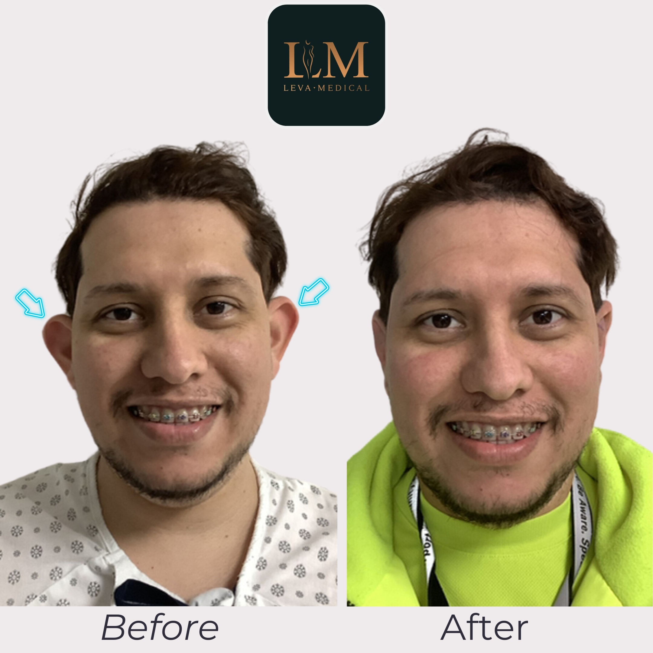 Before and after images of a patient who underwent ear pinning surgery.