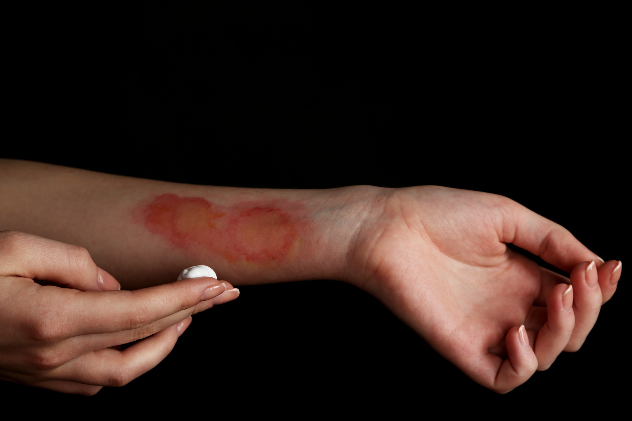 A woman's arm with third degree burns