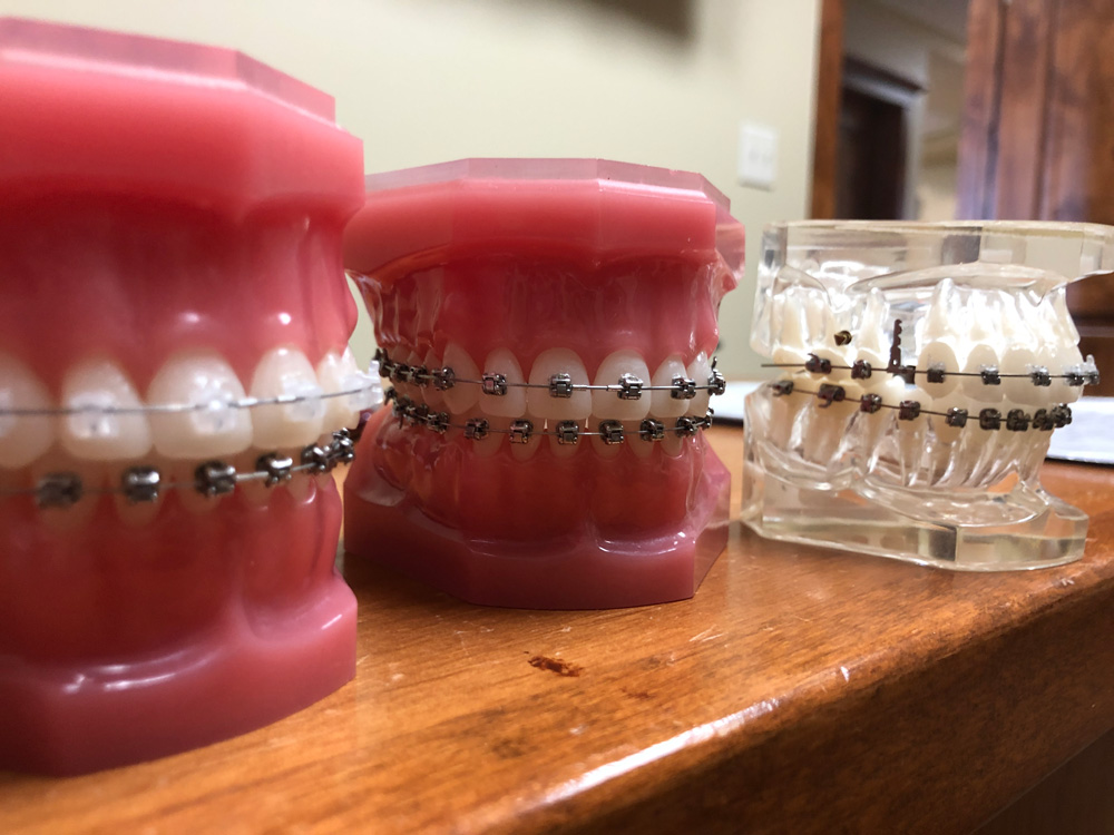 straighten teeth, self ligating damon braces, orthodontic treatments