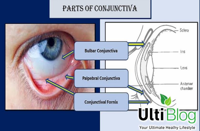 Eye graph explaining Mucus Fishing Syndrome