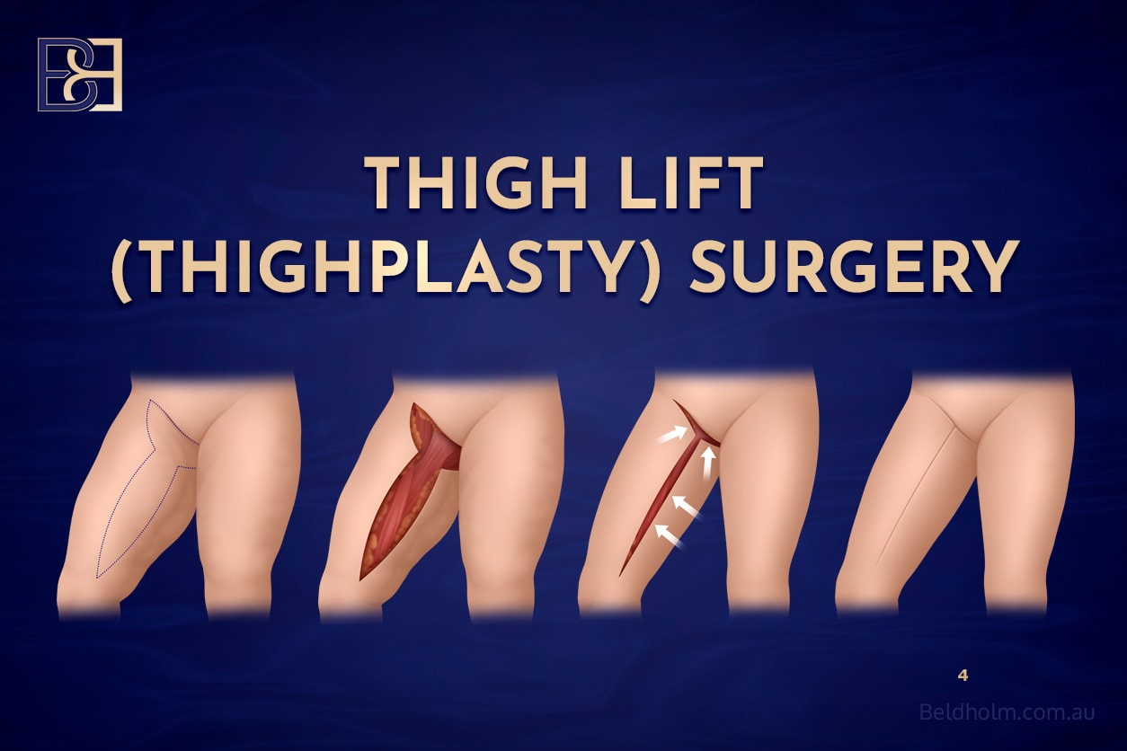 Complications After Thighplasty: Risks, Causes, and Management Options 1 Full Thighplasty (inner thigh lift)
