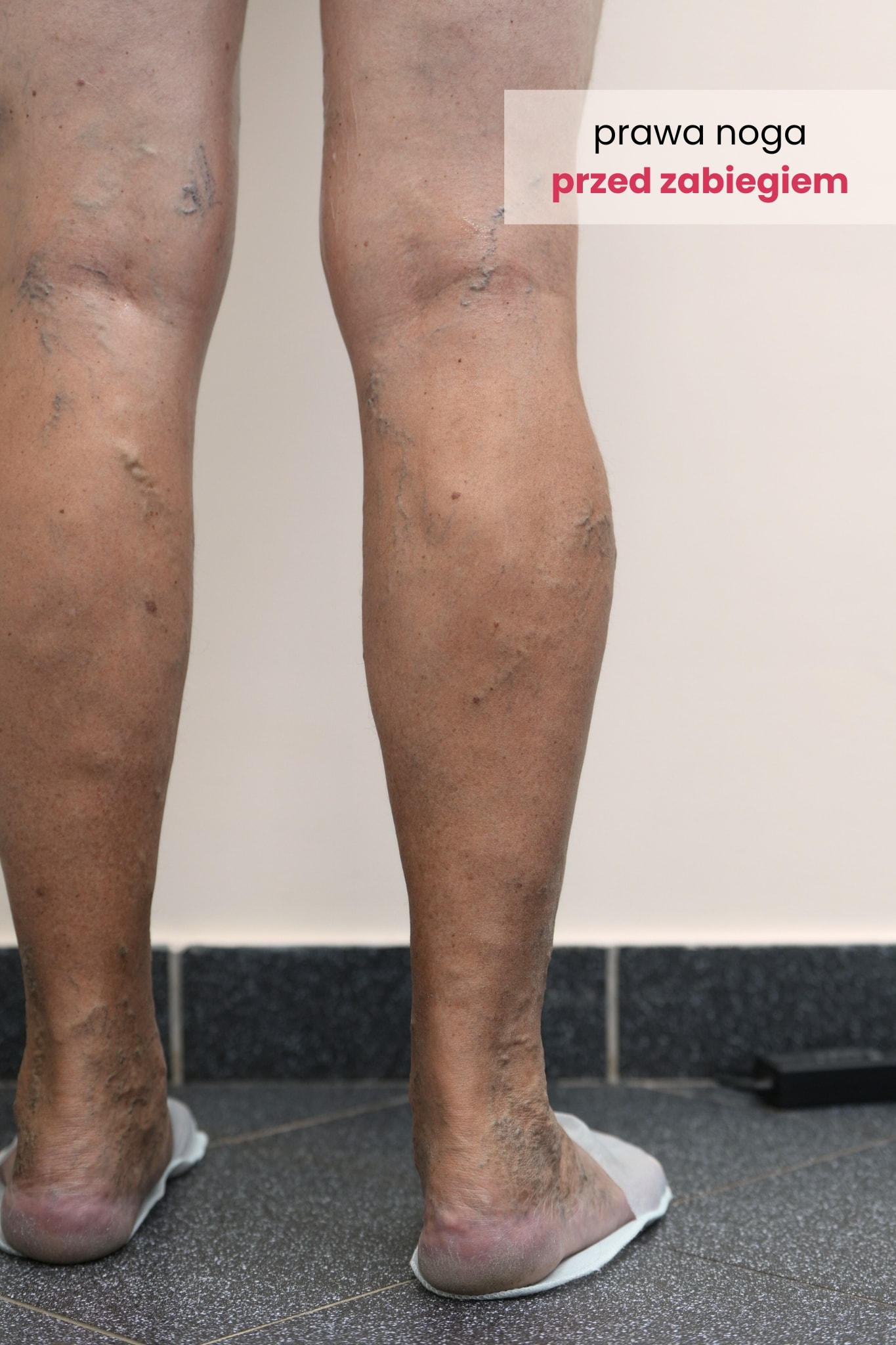 Zdjęcie prawej nogi Pacjenta przed zabiegiem skleroterapii