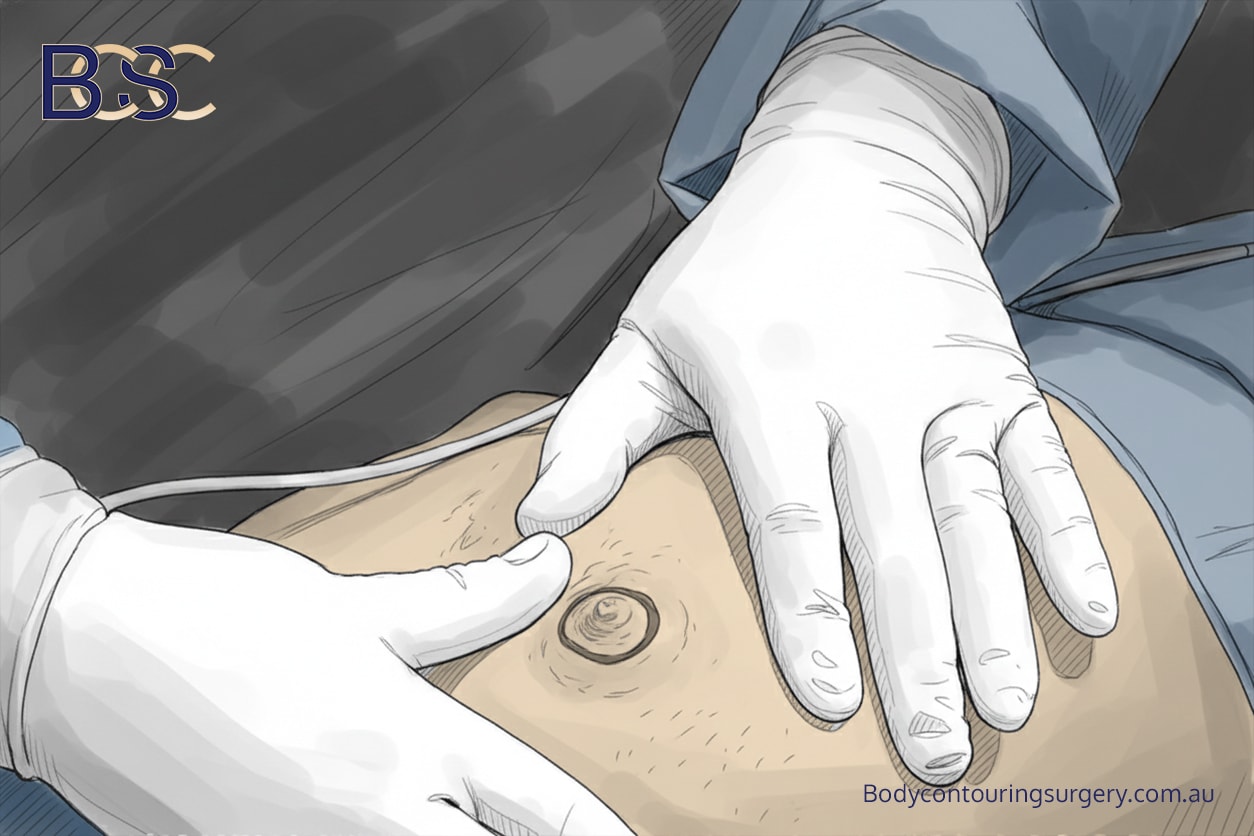 Nipple–Areola Complex (NAC) Graft Recovery