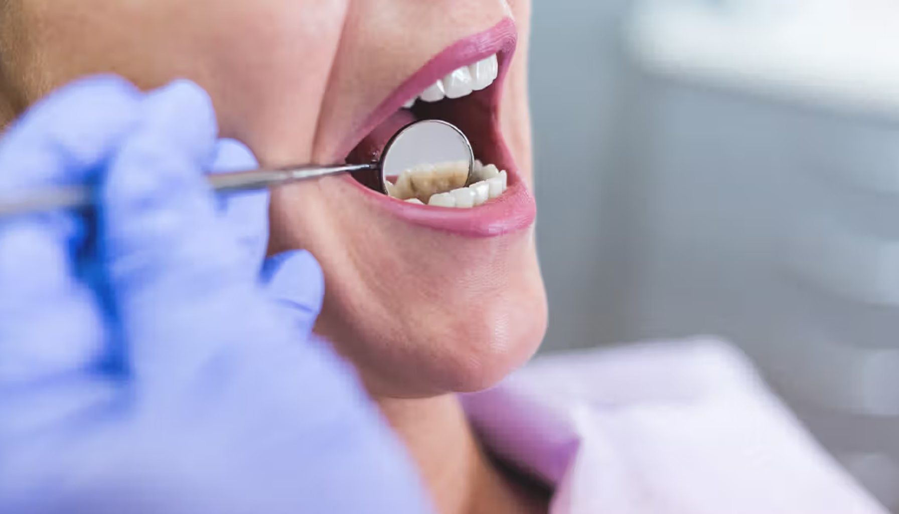 Vondt i Tann Etter Boring? Det Skal Ikke Være Slik 13 Tannlege undersøker tannstein på underkjevens tenner med speil i munnen til eldre kvinne med lilla hanske.