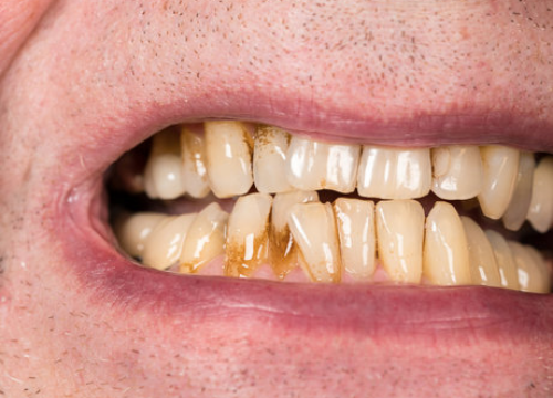 Black Stains on Teeth Causes Remedies and Treatment