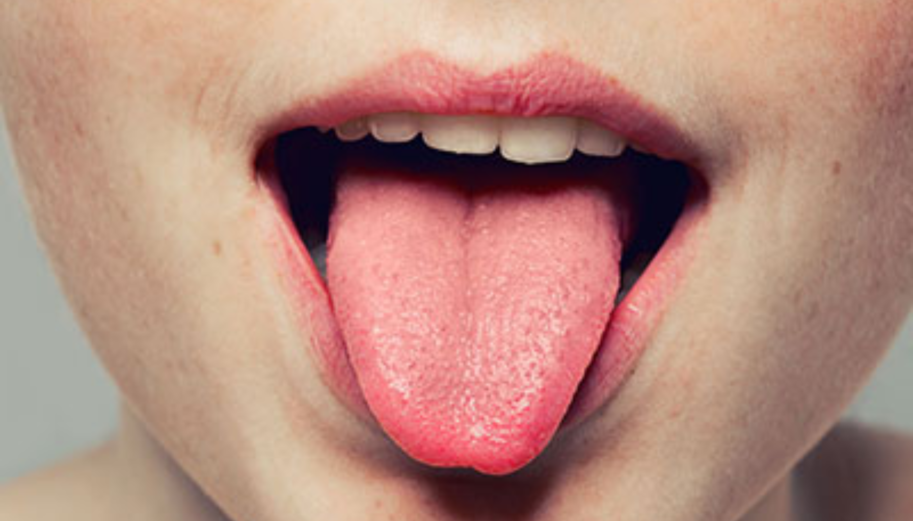 Person med åpen munn stikker ut tungen, viser frisk rosa overflate med synlige papiller. brennende tunge syndrom brennende munn syndrom burning mouth syndrome brennende munn syndrom bms brennende utelukke andre syndrom bms behandling munnen symptomer andre følelse tungen hos oral tilstanden årsaker finnes the årsak gir diagnosen behandlingen svie ofte smerten forskning lite del flere munnhulen bruk tillegg symptomene hele tilstand viktig smerte kvinner annet sammen leppene lengre vist viser norge smak psykologiske sykdommer vanlig lindre type rundt tilstander dag tar tyggegummi brukes depresjon bedre