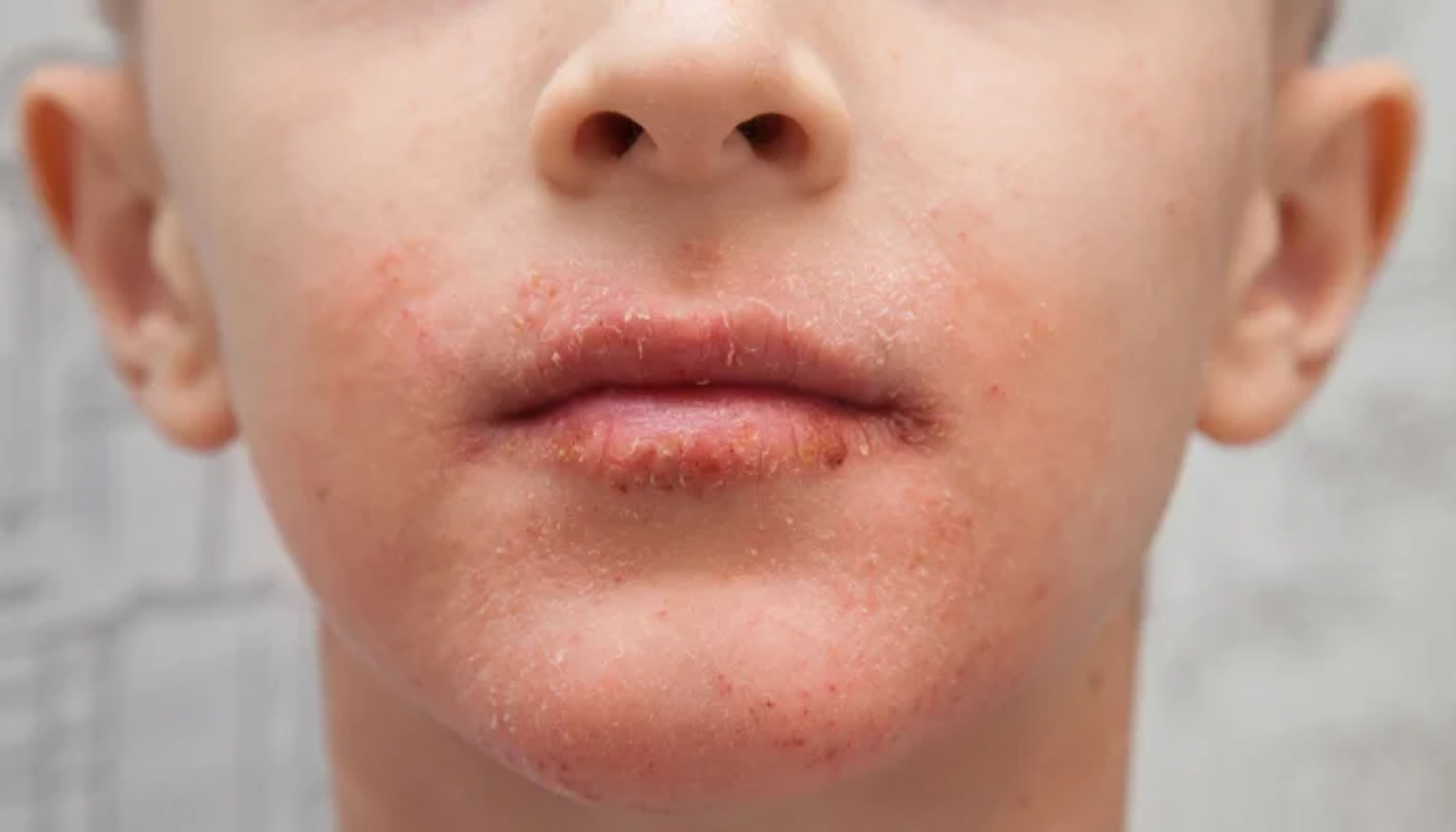 Barn med rød og irritert hud rundt munnen med skorper og små sår.» periorificial dermatitt perioral dermatitt utslett rundt munnen rundt munnen utslett rundt dermatitt rundt øynene hos kvinner p piller små røde behandling bruk tilstanden hos utslettet huden hudlege kvinner ofte ansiktet årsaken unngå våre faktorer nese antibiotika munn gir bør små krem