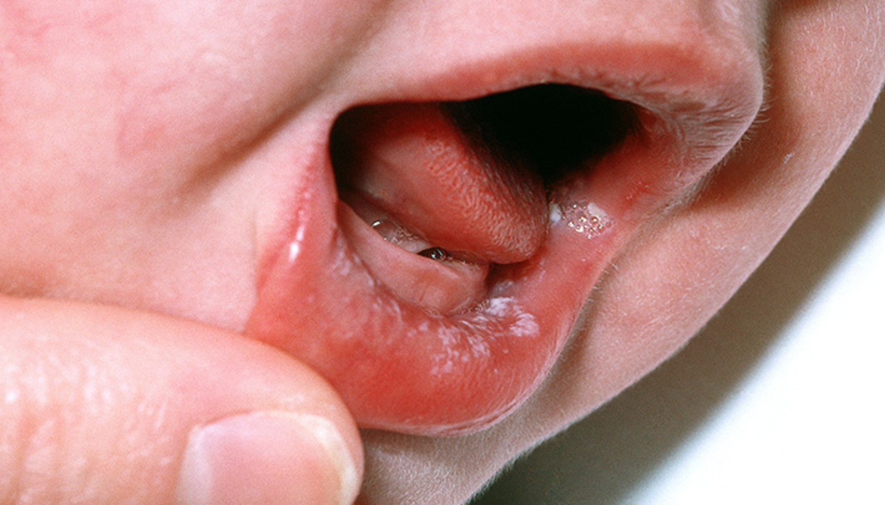 Trøske i Munnen: Ikke Bare for Babyer 13 Små hvite sår og blemmer på innsiden av et barns underleppe, typisk for herpesinfeksjon eller munnsår i tidlig barndom.