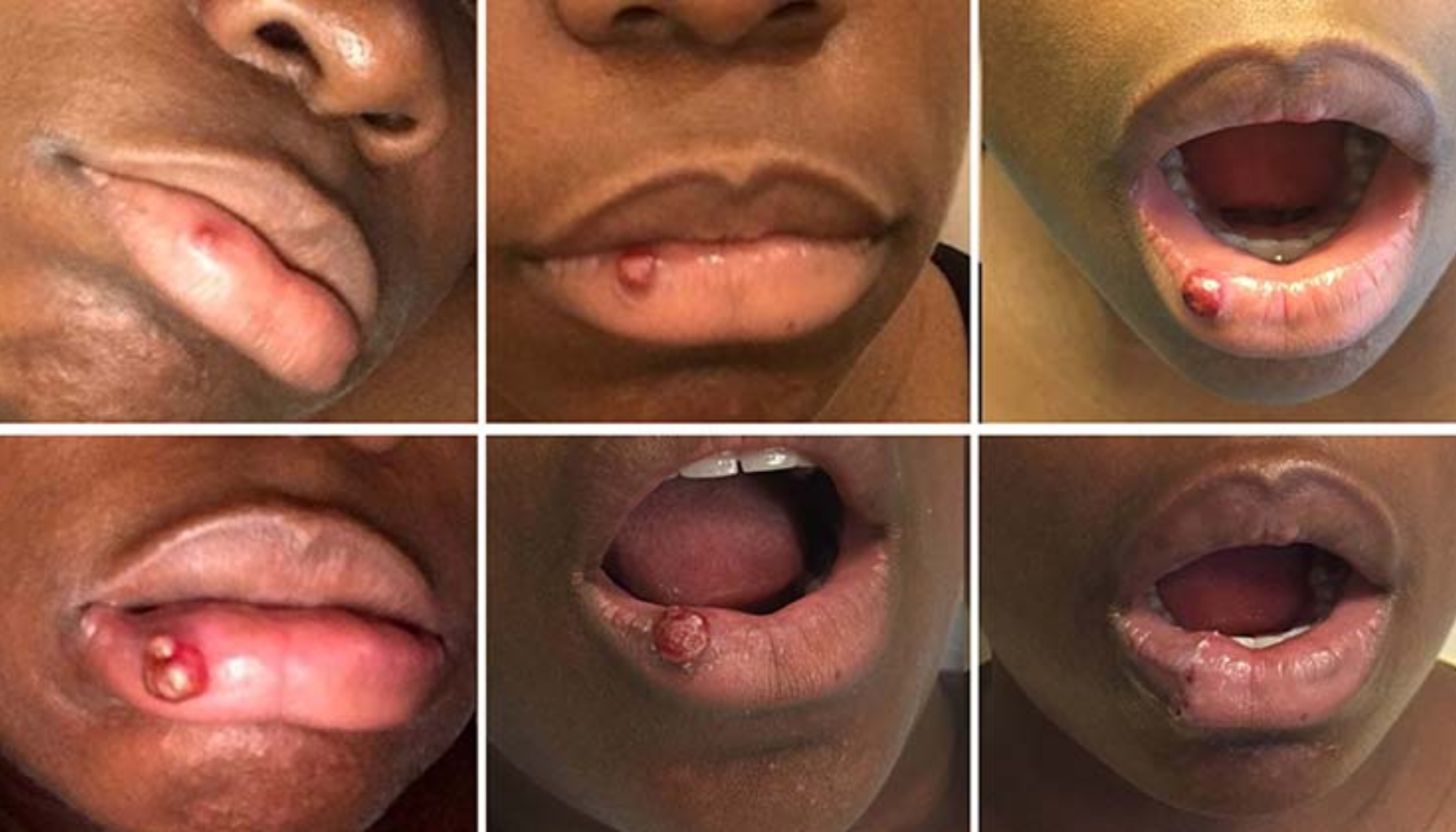 Hard Klump i Underleppa – Hva Kan Det Være? Hard Klump i Underleppa – Hva Kan Det Være?