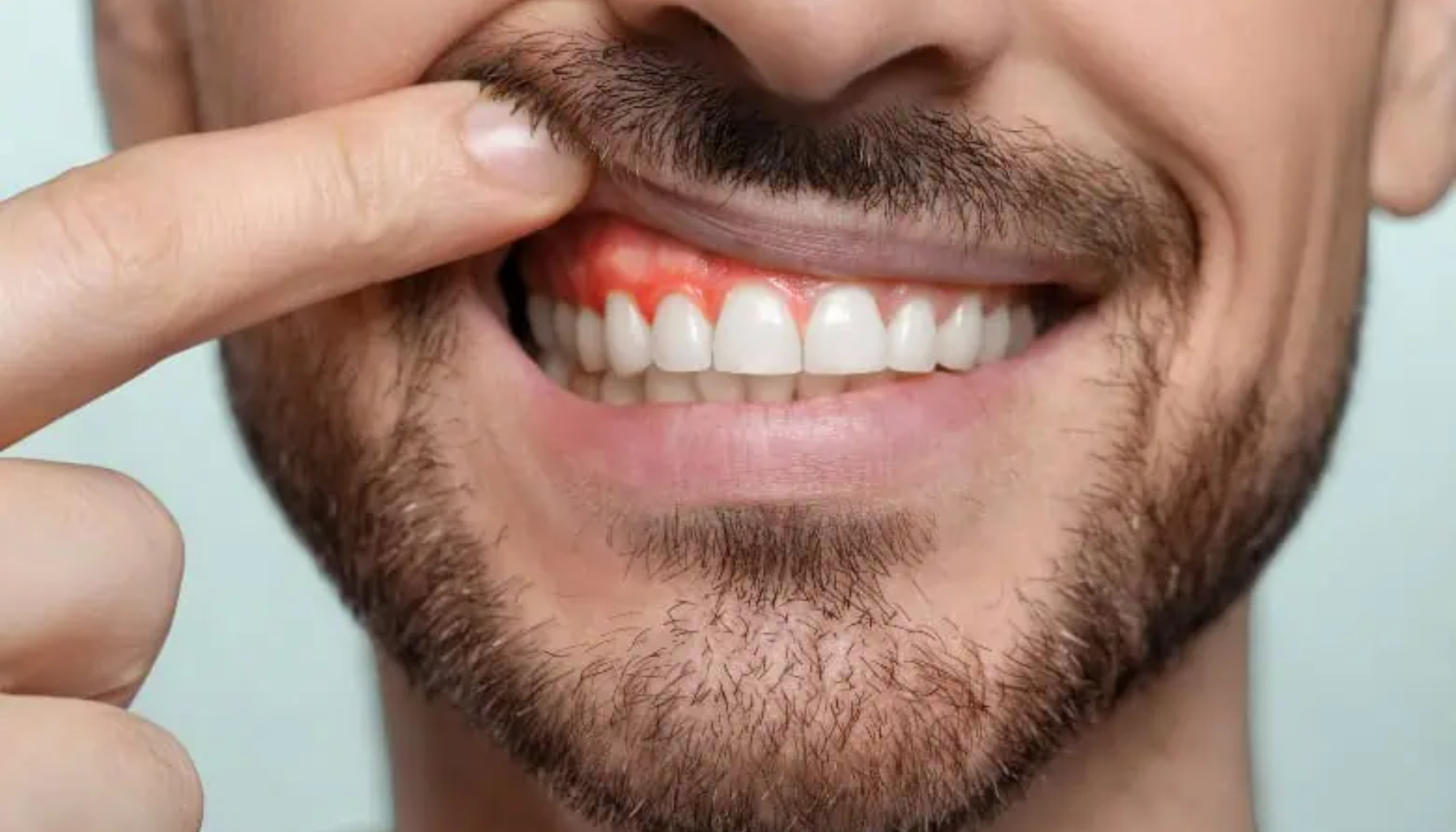 Hvordan Forebygge Tannkjøttbetennelse: En Omfattende Guide 11 Mann trekker opp overleppen for å vise rødt og betent tannkjøtt foran hvite tenner.