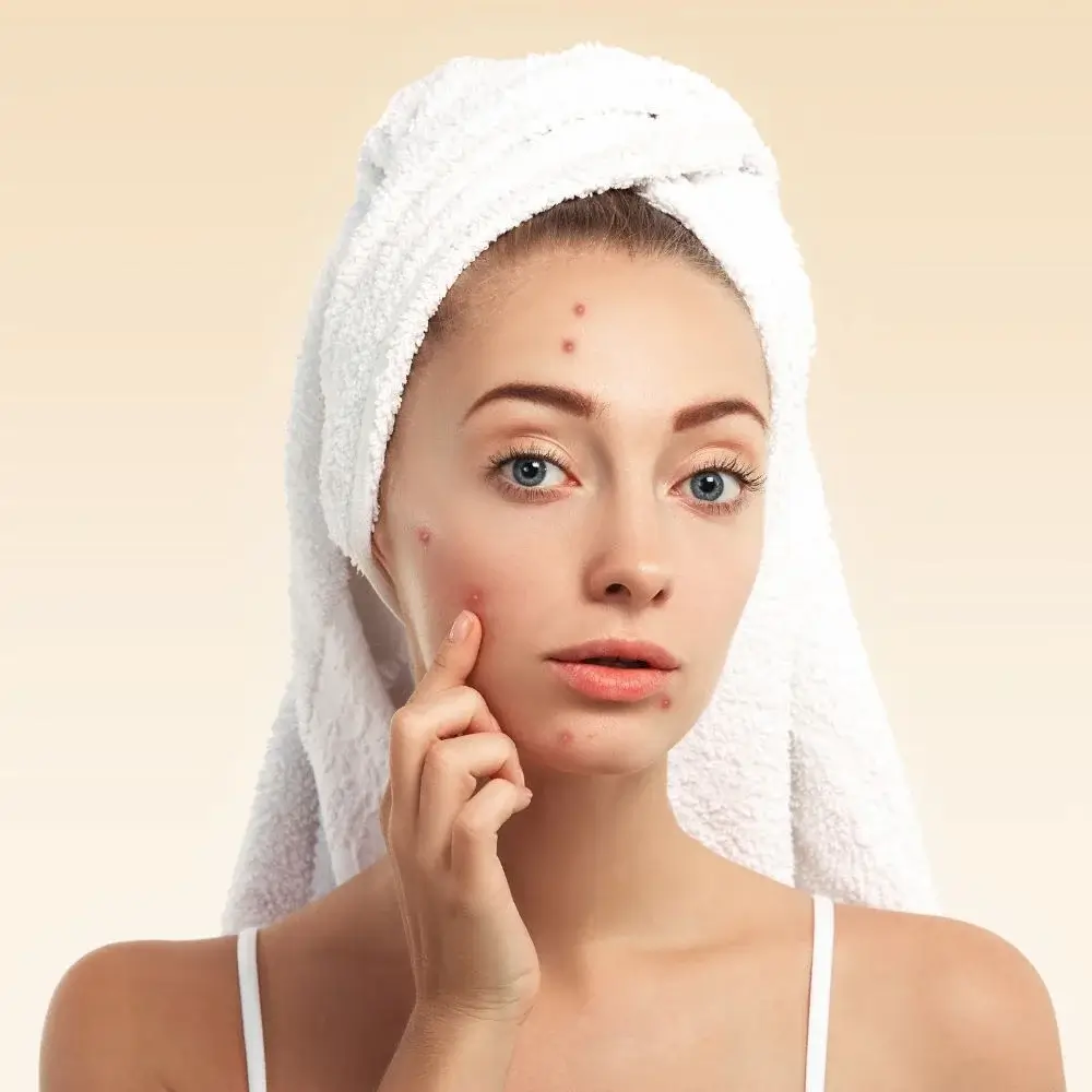 Enhancing Beauty with the Best Blush for Acne Prone Skin Complexions In 2023