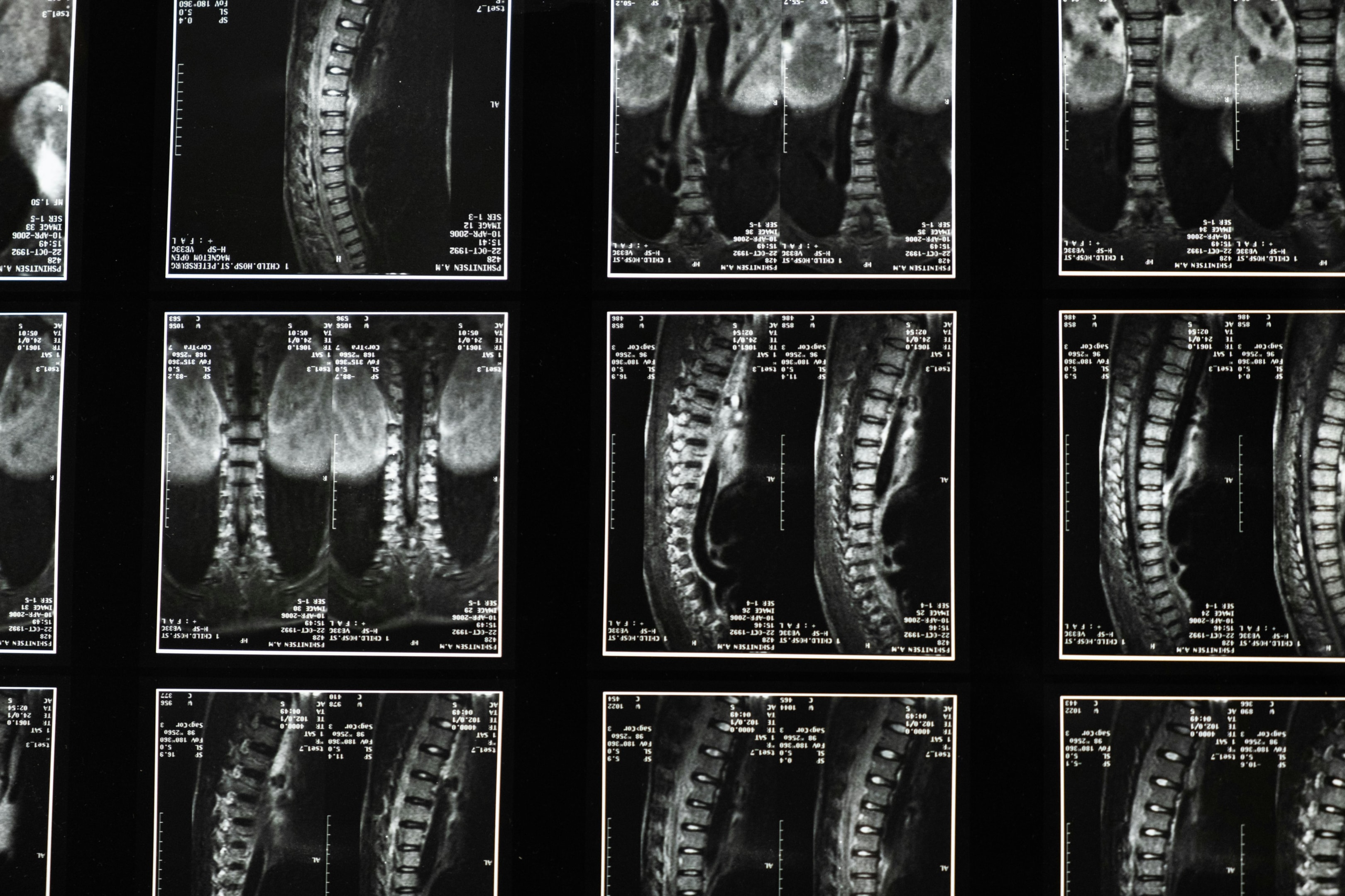 A spinal xray