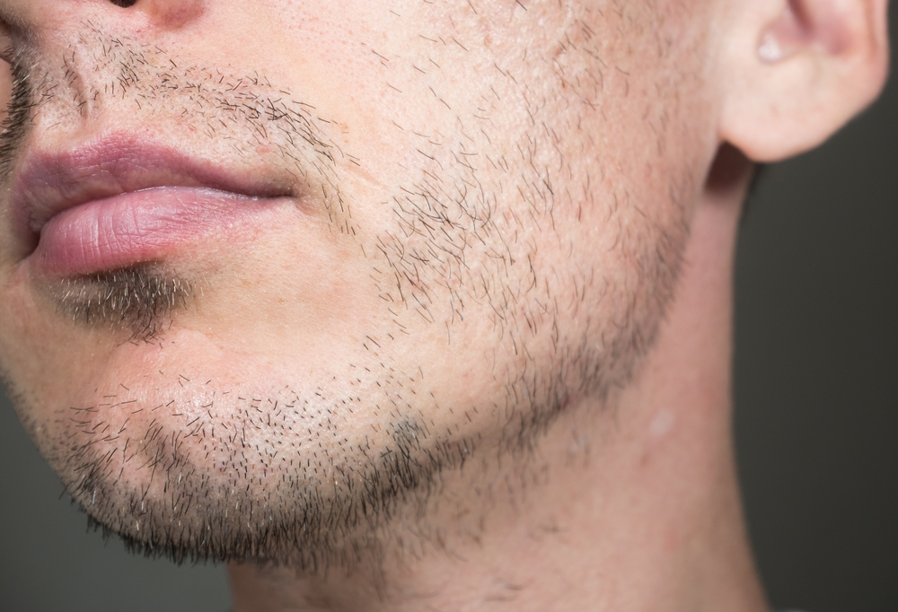 Young man with patchy beard growth