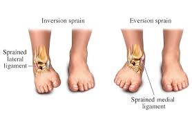 Depiction of lateral and medial ankle sprains displaying the different mechanisms of injury with the lateral ankle injury rolling outwards, and the medial ankle injury rolling inwards.