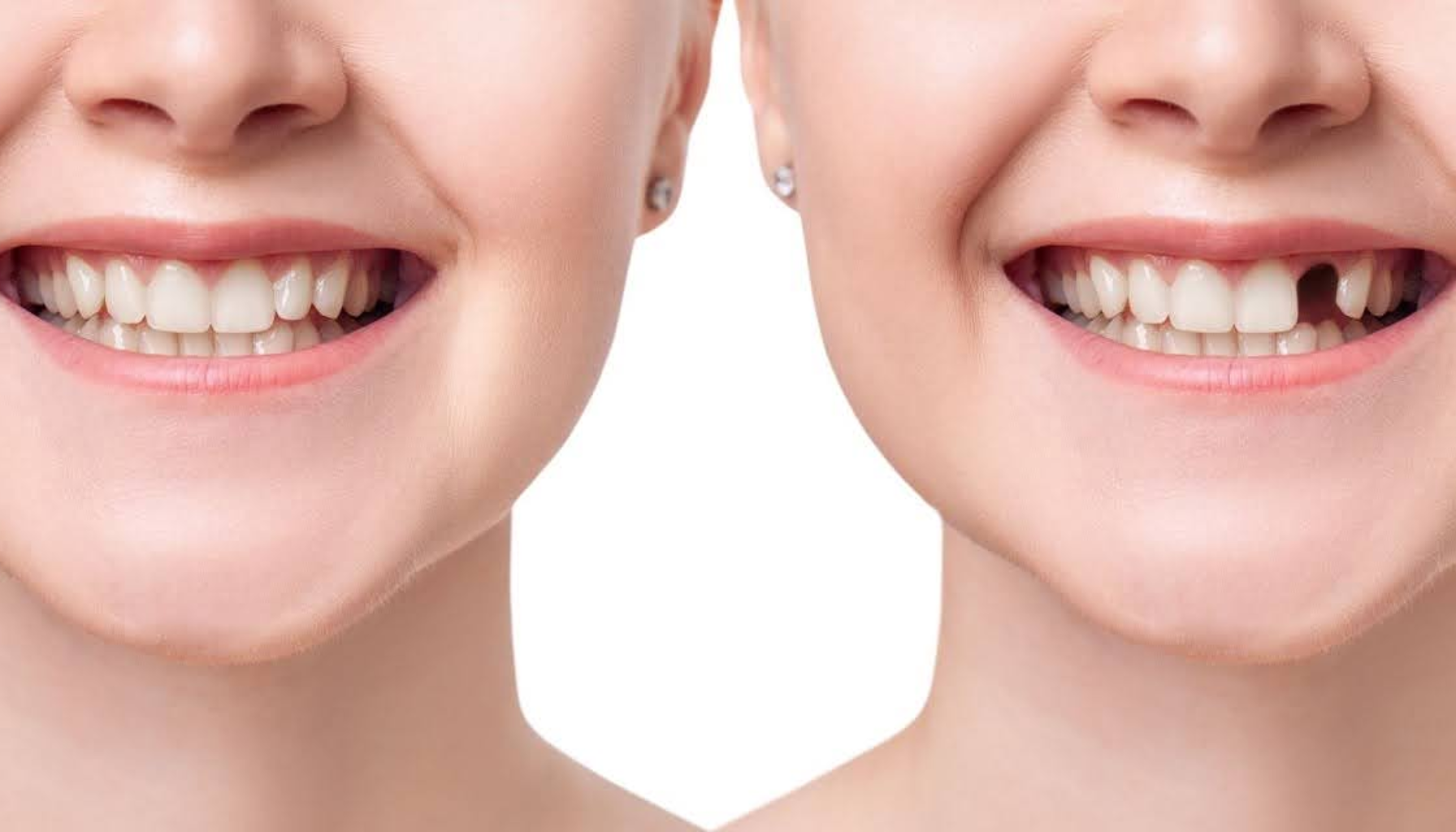 Tapptann: Når En Tann Går Tapt og Hva Du Kan Gjøre Videre 1 To smilende munnbilder side ved side viser før og etter tannbehandling med jevnere tenner og bedre estetikk