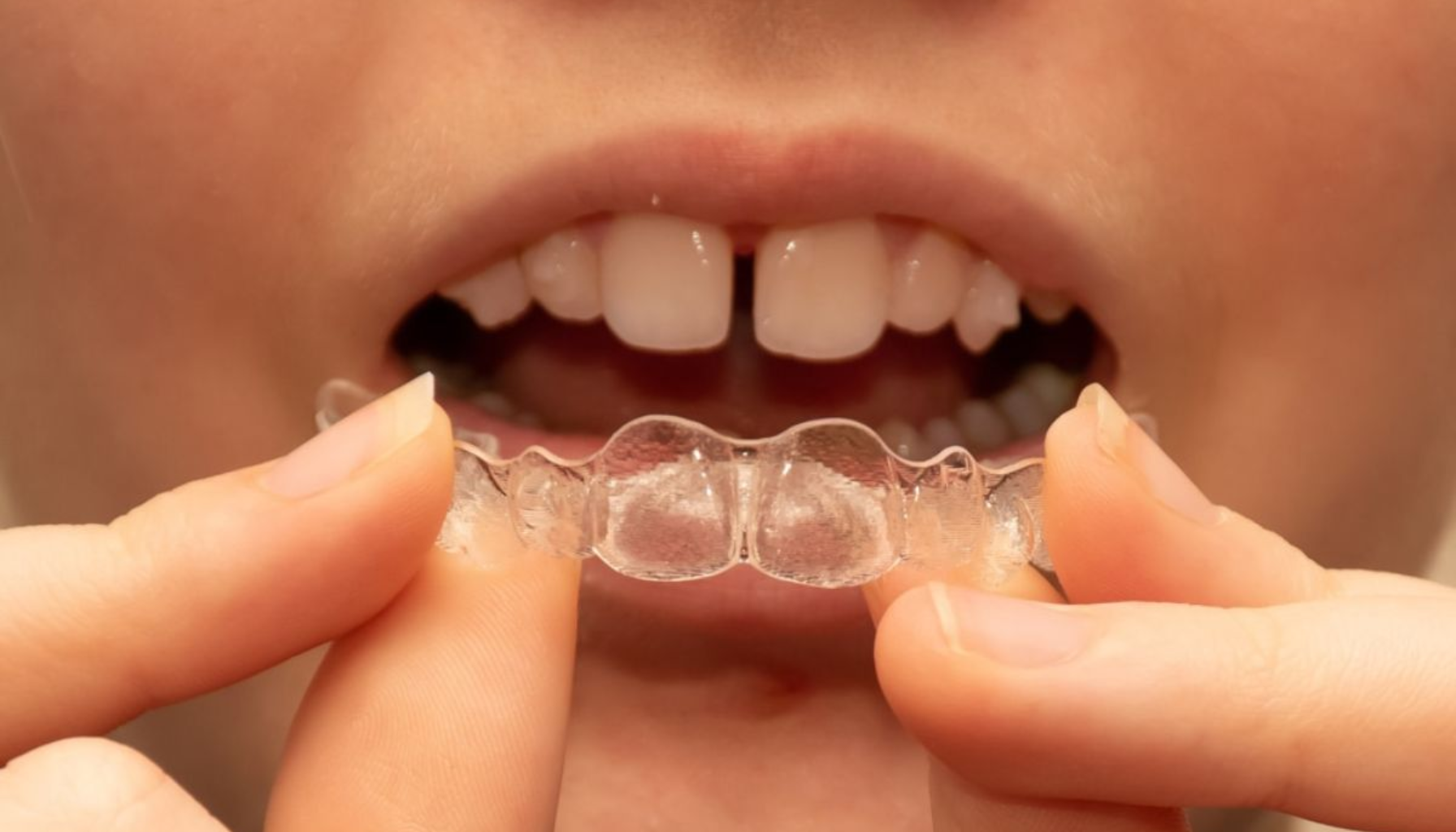 Mellomrom mellom tennene: Estetikk og tannhelse hånd i hånd 11 Barn holder en klar tannreguleringsskinne foran tennene med begge hender i nærbilde. mellomrom mellom tennene mellomrom mellom fortennene mellomrom mellom tenner lukke mellomrom mellom tennene tennene dine lukke mellomrom finnes det flere tennene mellomrom tenner fortennene tannregulering behandling mellomrommet tannlegen fasetter hos dine mer finnes kroner mindre føre flere naturlig brukes diastema estetisk smil gjør fyllinger regulering gir ønsker tannlege ofte derfor redusere andre tid tann gjøre alternativ fylle invisalign tannen trenger bør naturlige større fjerne del behov tannleger smilet viktig best hverandre effektivt tilfeller mennesker behandlinger likevel ulike mest behandlingen nok under hjelpe helt vanlig stort holde dekke skinner alternativet kalles bilder dag store sjarmerende