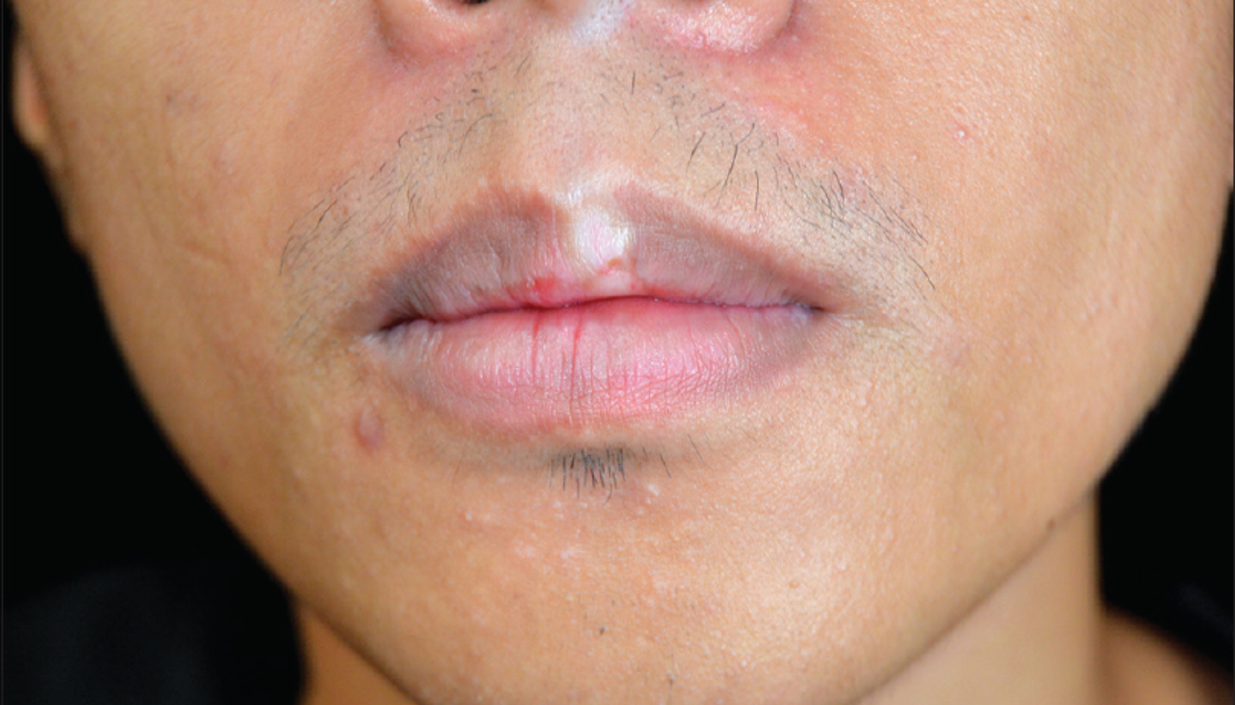 Hudforandringer og lysere flekker rundt munnen hos voksen mann.