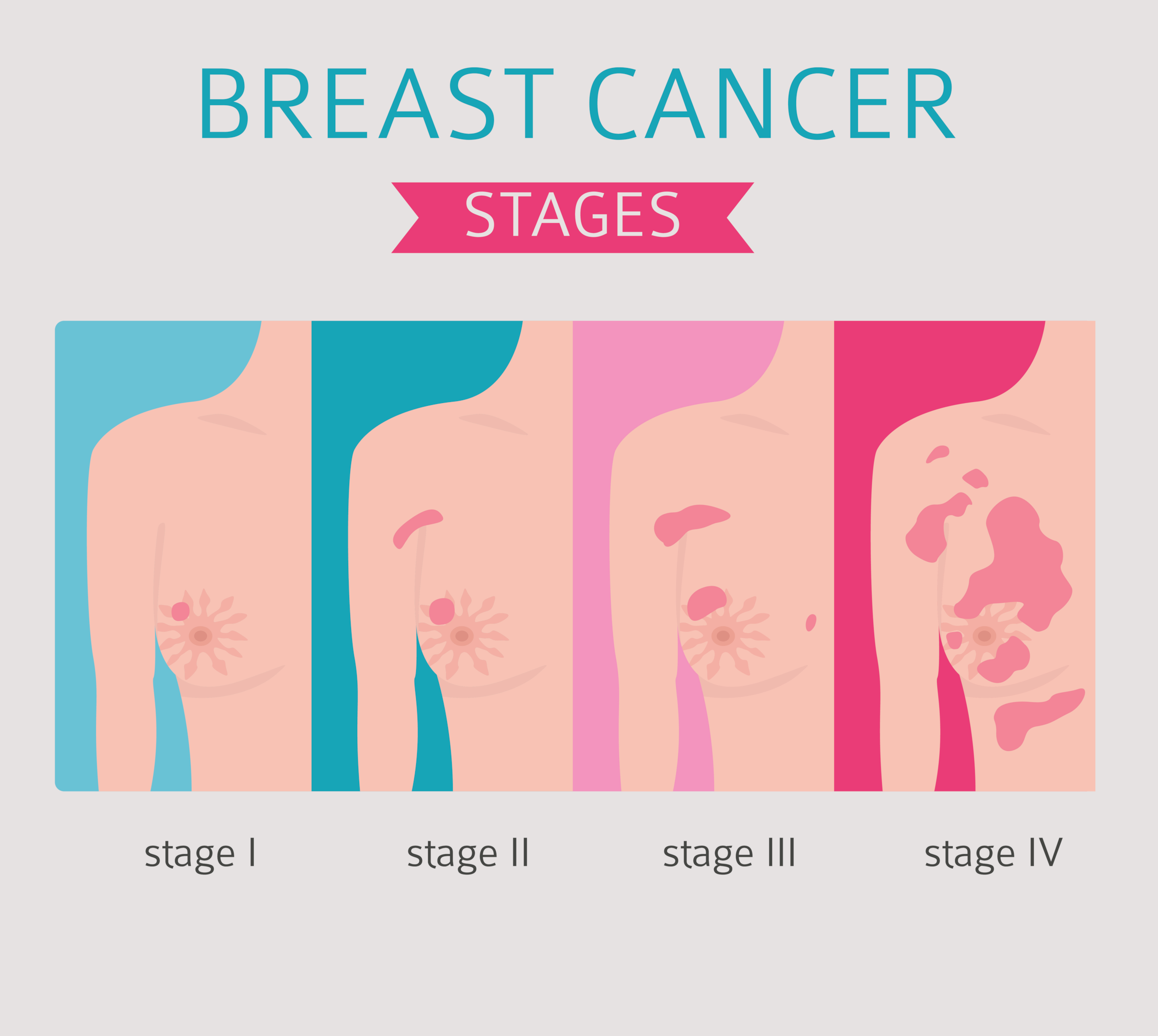 RMN San,rmn mamar,rmn mamar pret,rmn san bilateral,RMN mamar bilateral,RMN san cu substanta de contrast,RMN mamar cu substanta de contrast,rmn de san stadializare cancer de sân / cancer mamar