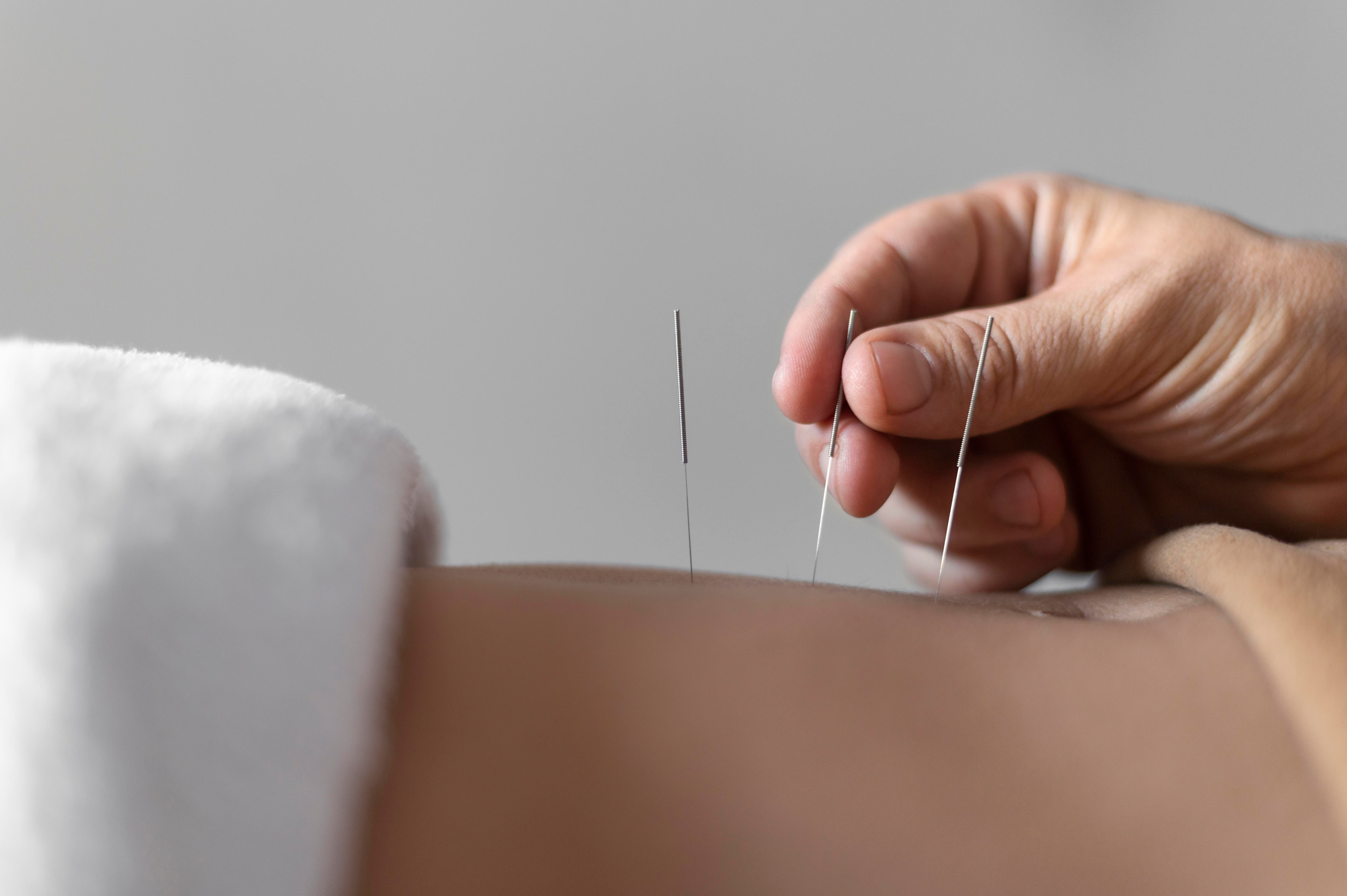 Acupuncture involves pricking fine needles at a specific point on the body.