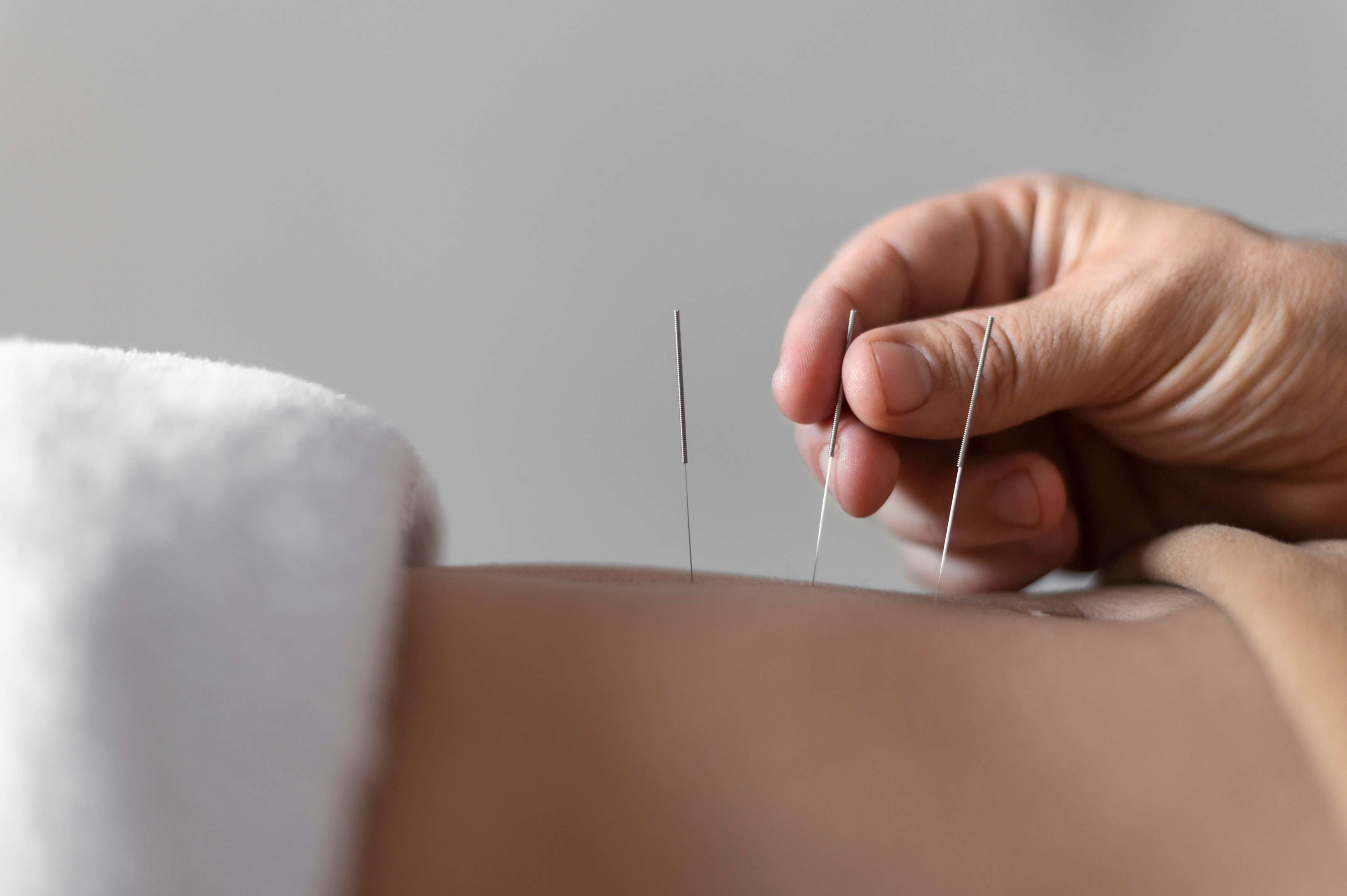 L'acupuncture implique des aiguilles fines piquant à un point spécifique du corps.