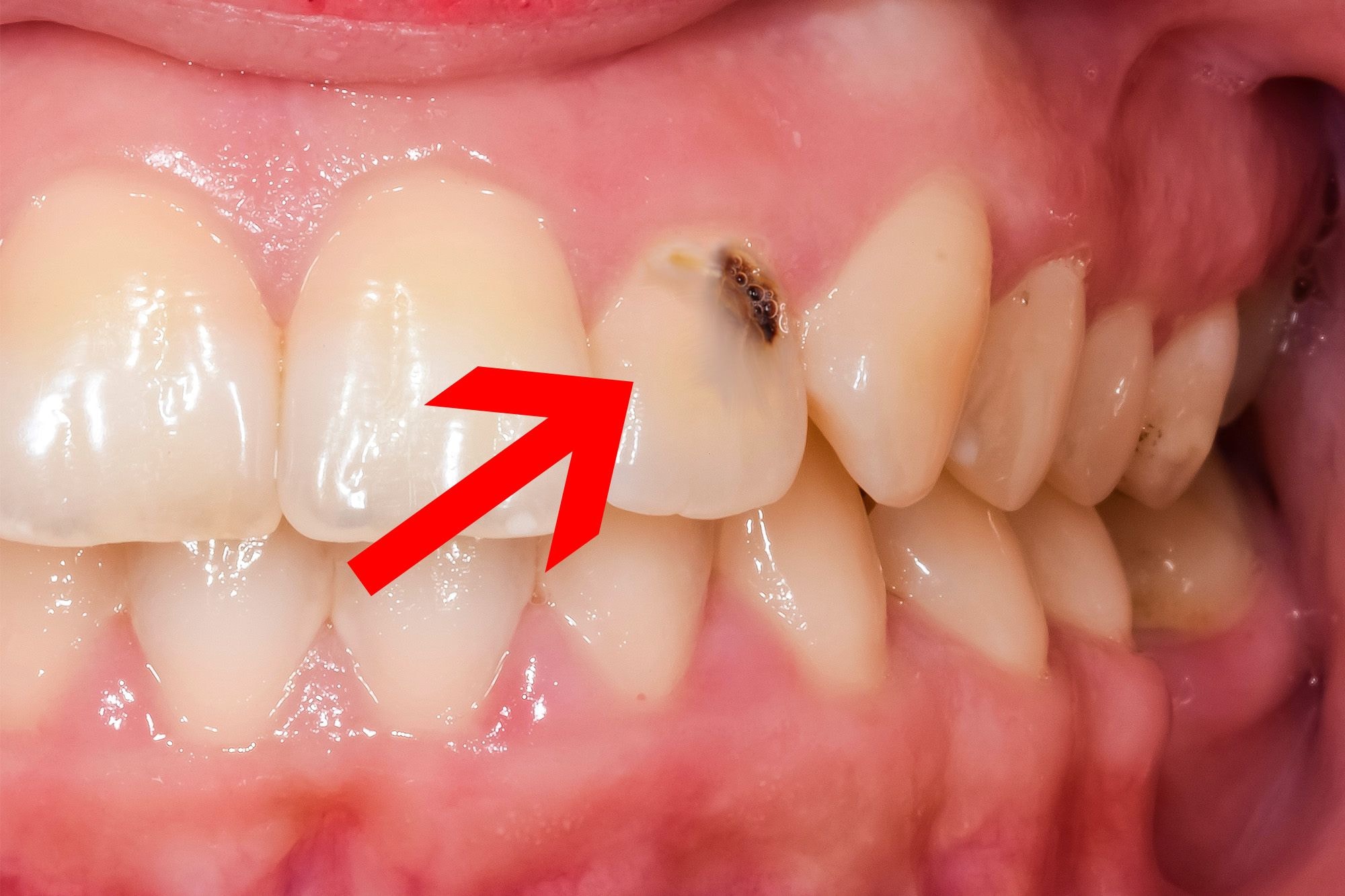 Cavity shown on tooth