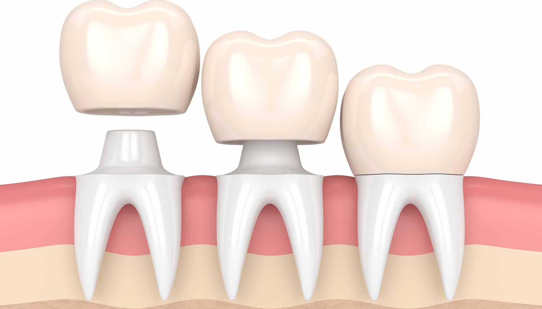 "Illustrasjon av tannkrone som plasseres på tannstøtte, brukt for å gjenopprette skadet eller svekket tann."