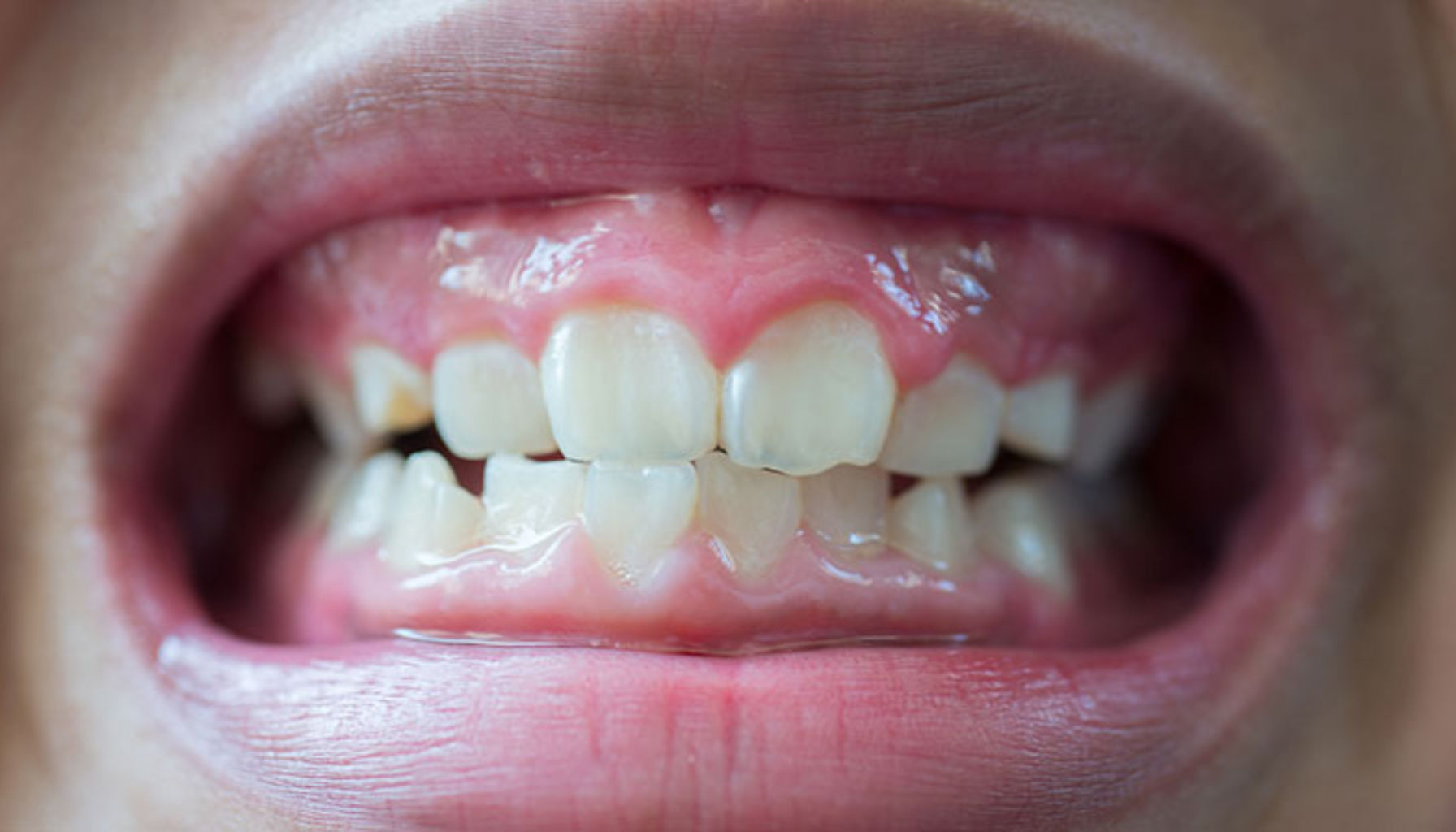 Erosjon på Tennene: Den Usynlige Skaden Du Ikke Merker Før Det Er For Sent 2 Nærbilde av bitt med skjeve og uregelmessige tenner, mulig behov for tannregulering.