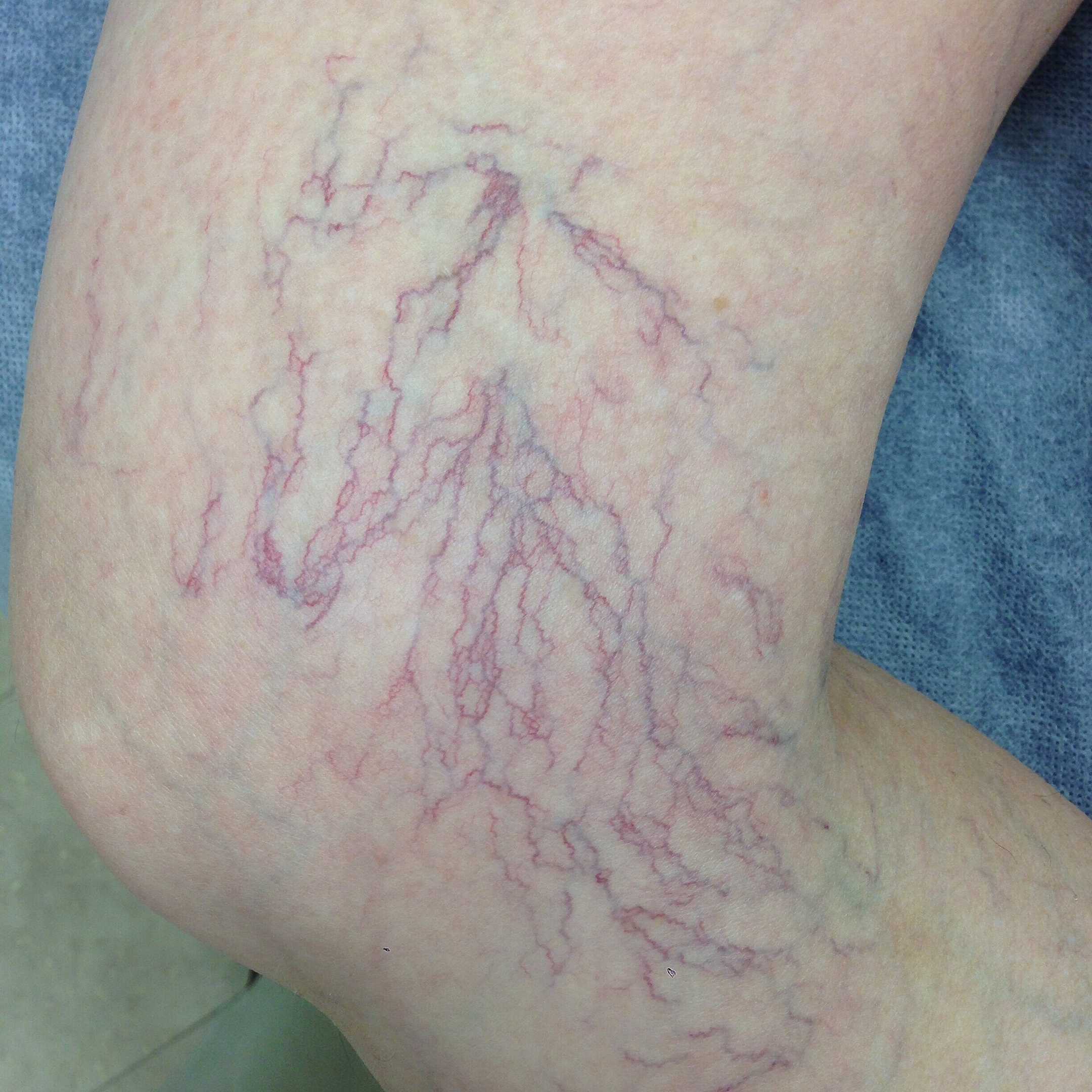 Vein Treatment At Vascular Institute