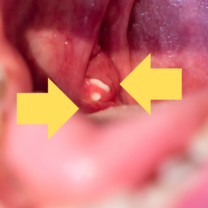 An image of swollen tonnsils with pus indicating tonsillitis.