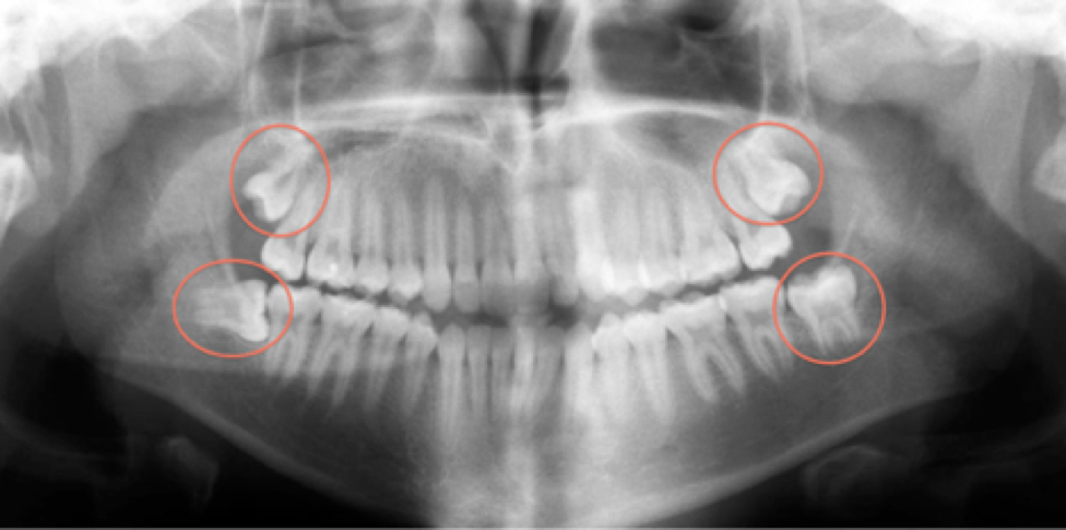 X-ray showing the wisdom teeth 