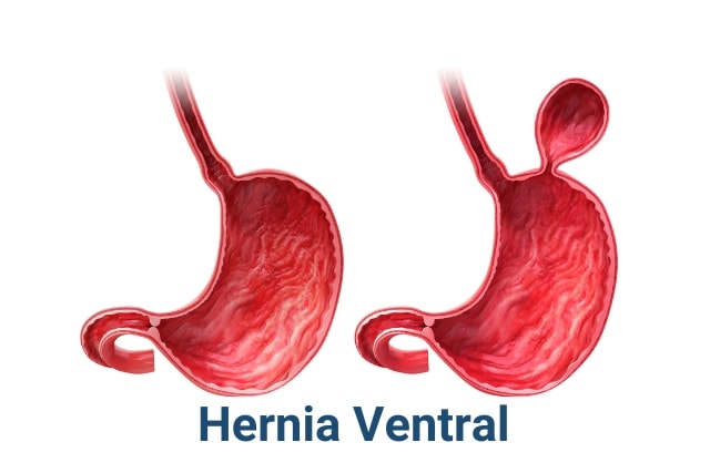 hernia ventral