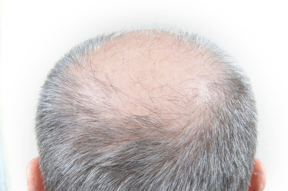 thinning hair and receding hairline caused by male pattern hair loss