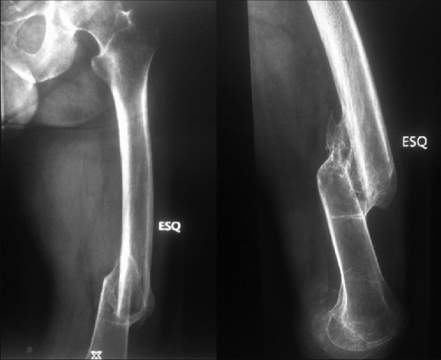 Malunion of femoral shaft fracture