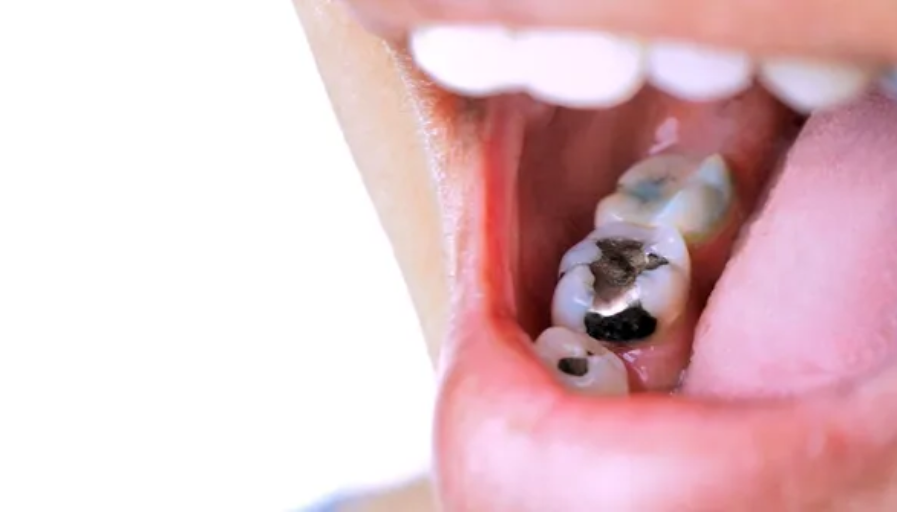 «Nærbilde av tann med alvorlig hull og karies, omgitt av andre tenner og rosa tannkjøtt.»